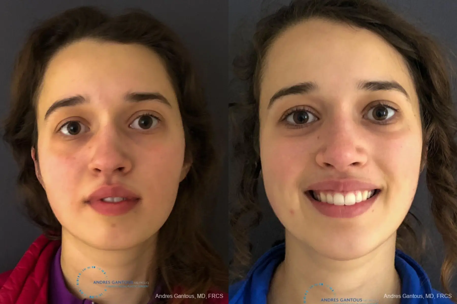 Rhinoplasty: Patient 4 - Before and After  