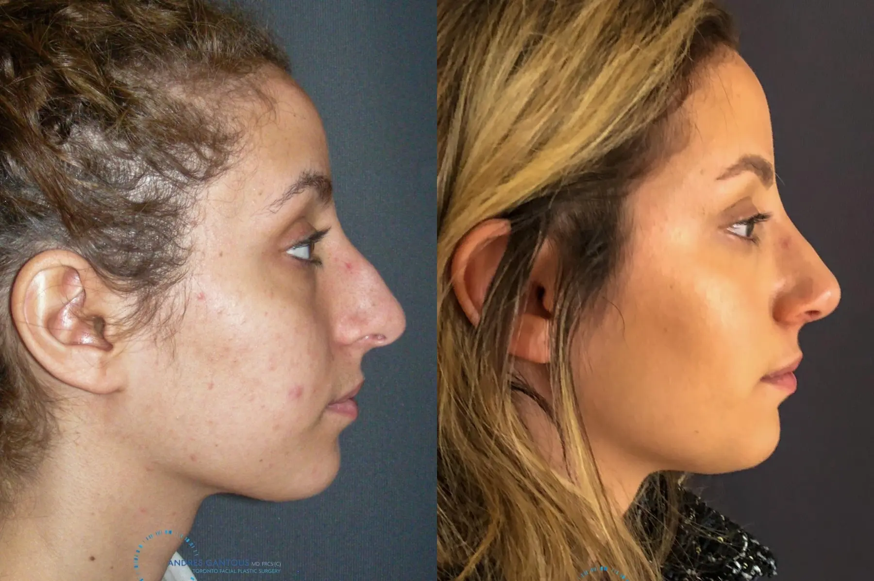 Rhinoplasty: Patient 72 - Before and After 5