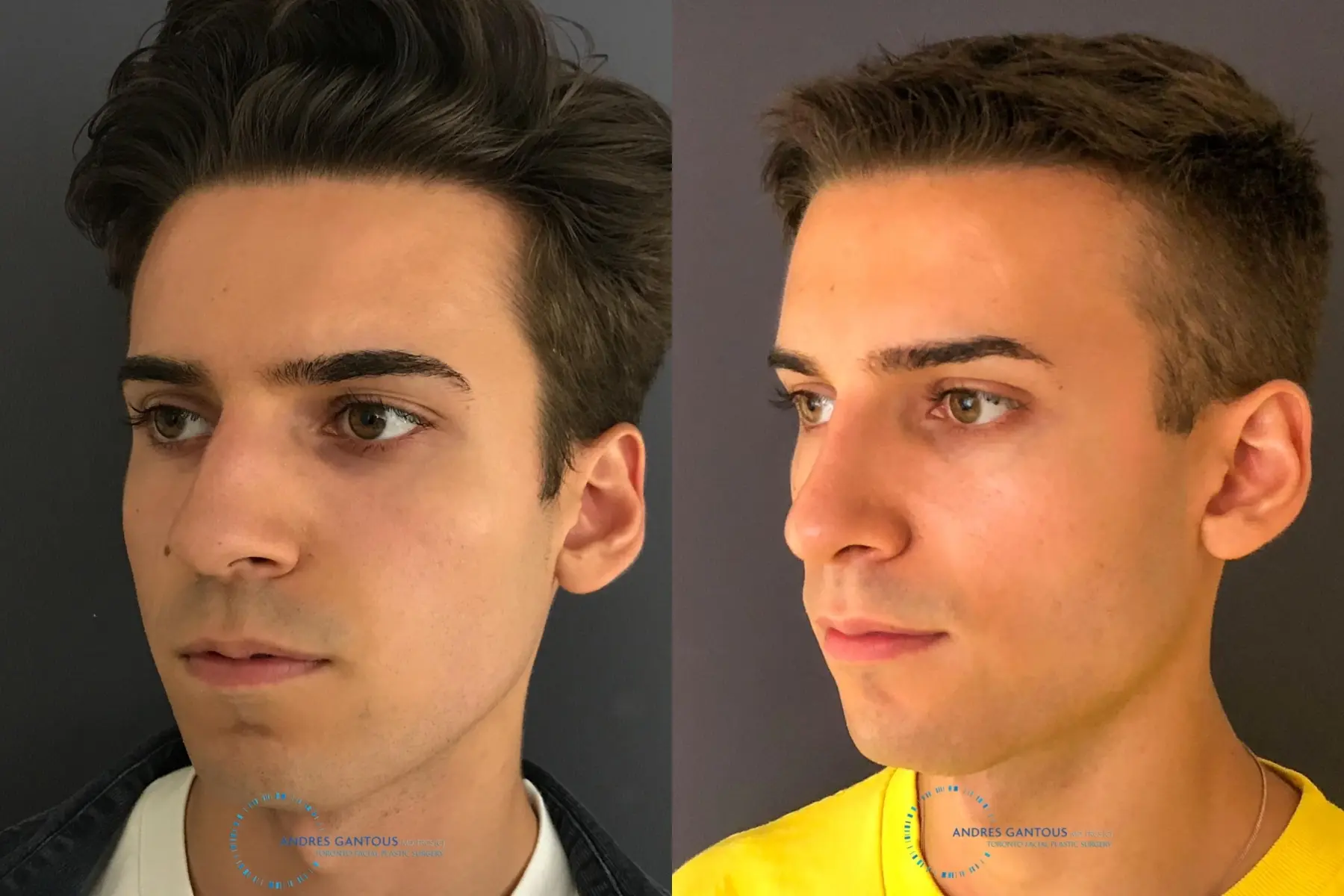 Rhinoplasty: Patient 65 - Before and After 3