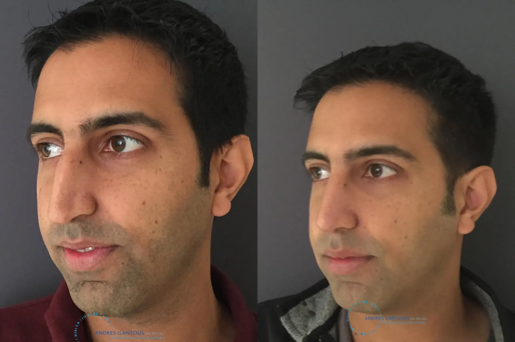 Rhinoplasty: Patient 76 - Before and After 4