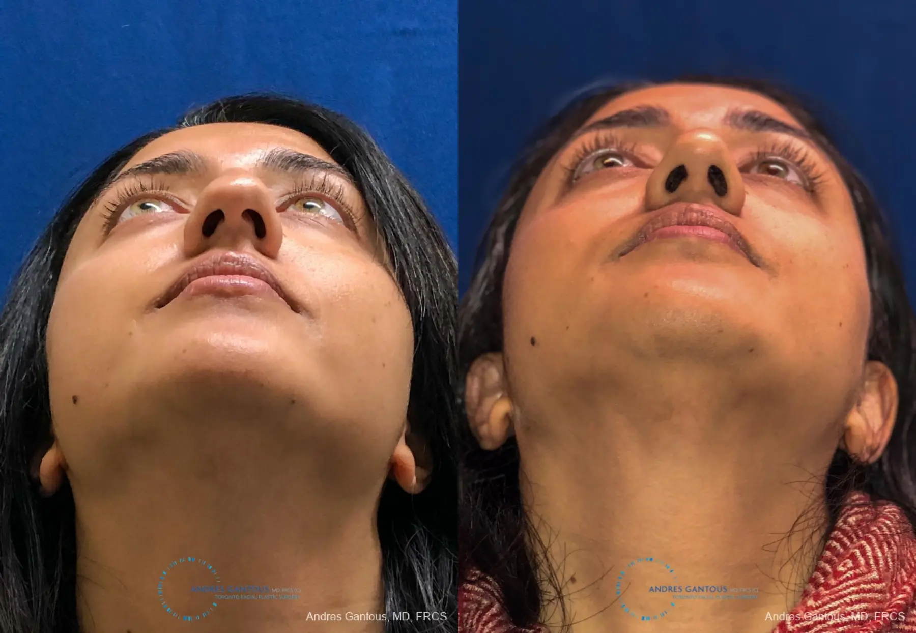 Rhinoplasty: Patient 80 - Before and After 2