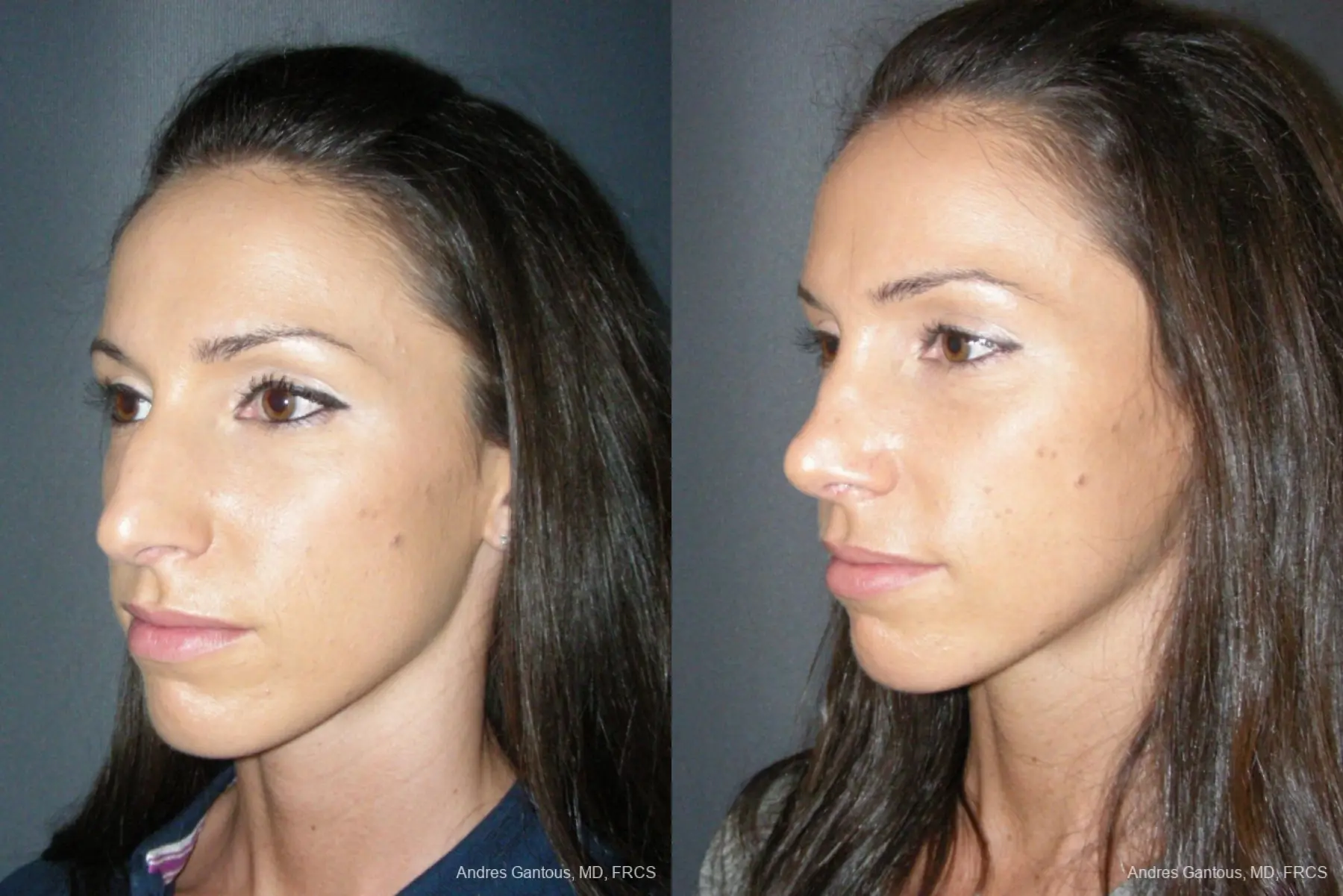 Rhinoplasty: Patient 52 - Before and After 2