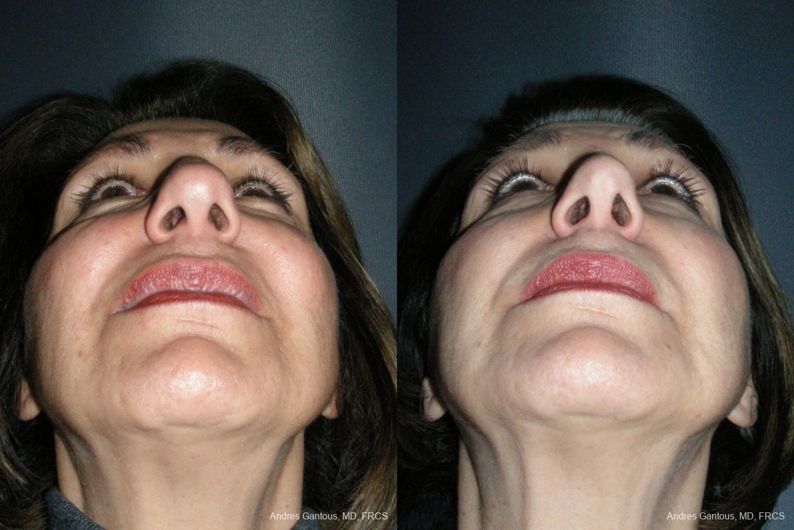 Rhinoplasty - Thumbnail 6