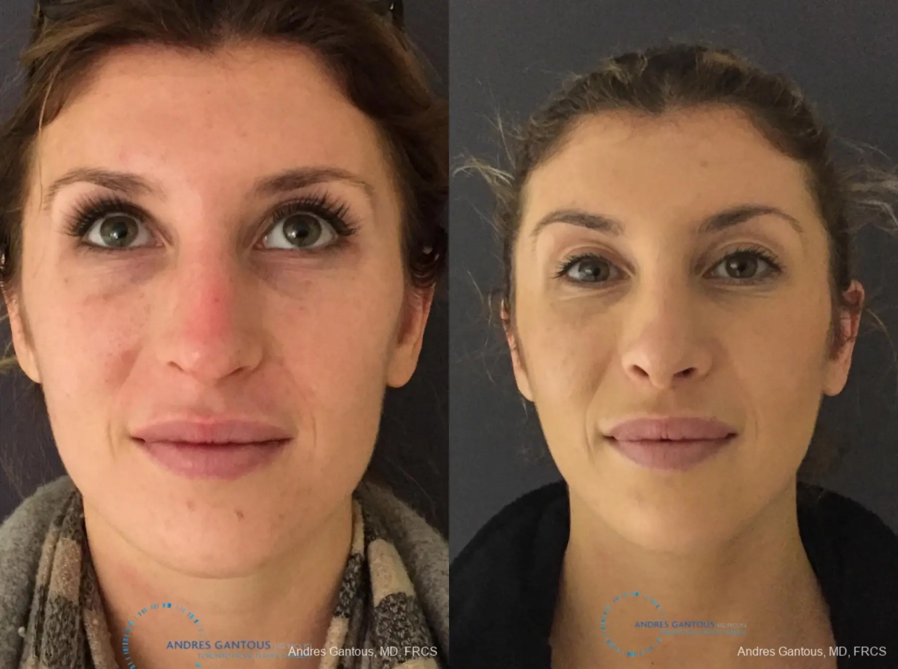 Rhinoplasty: Patient 77 - Before and After 1
