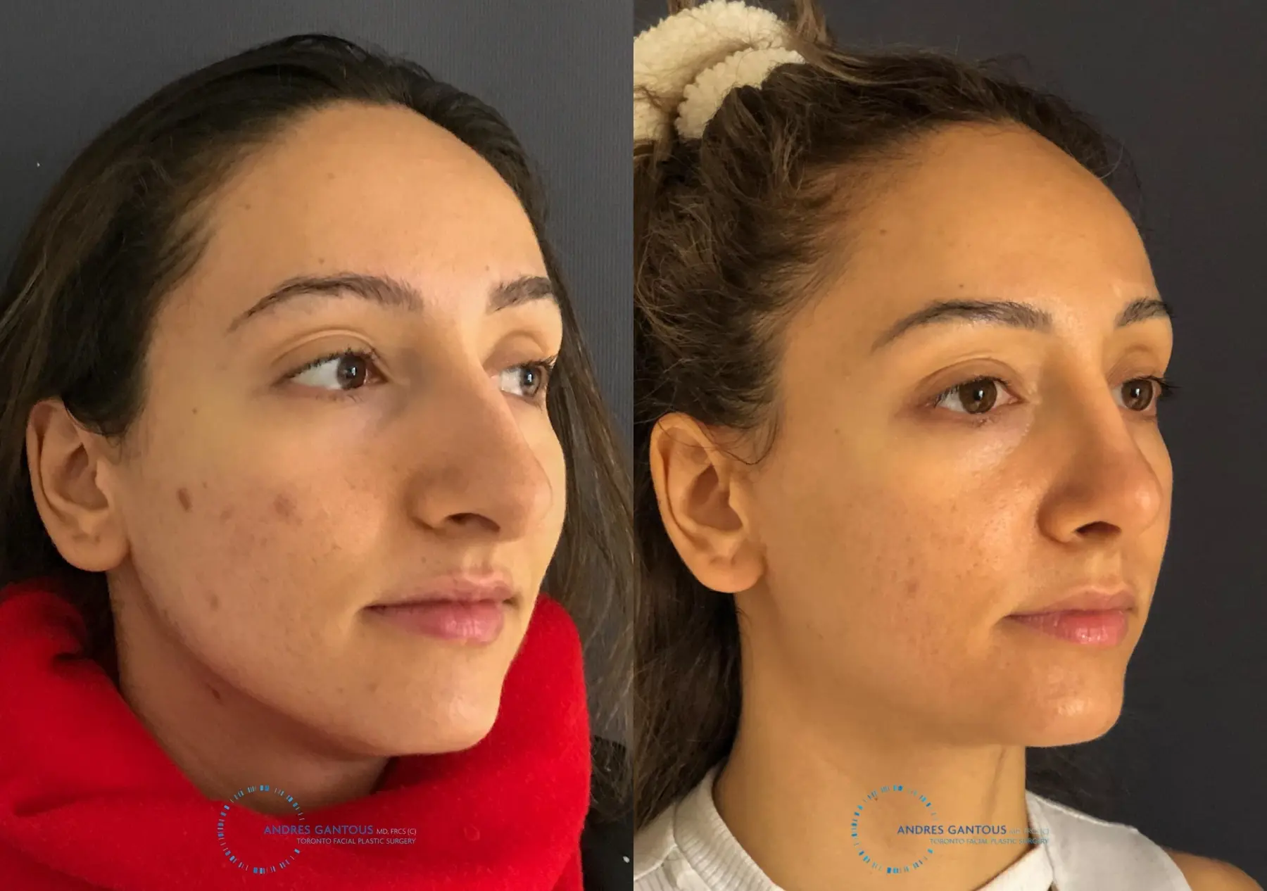 Rhinoplasty: Patient 59 - Before and After 3