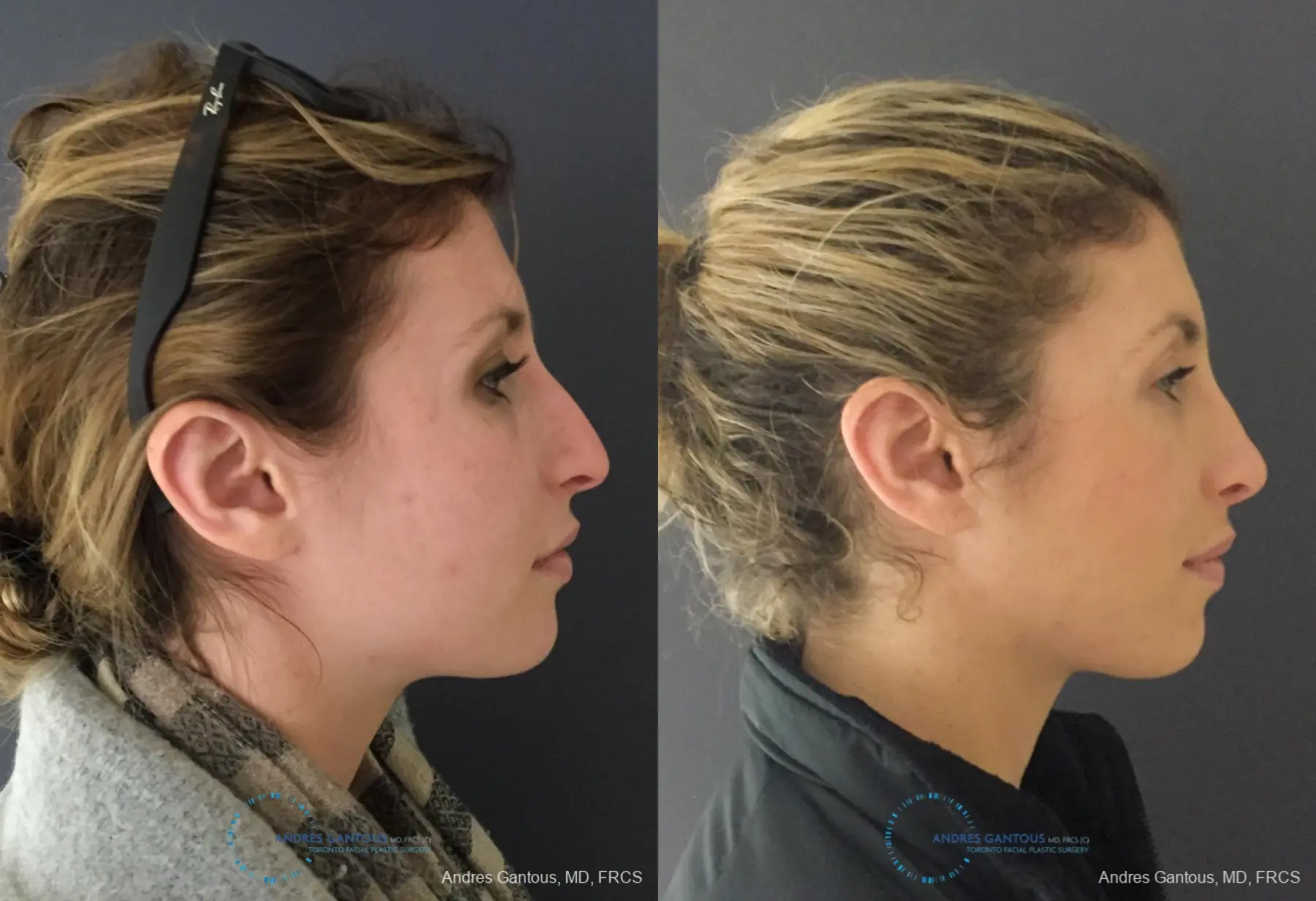 Rhinoplasty: Patient 79 - Before and After 5