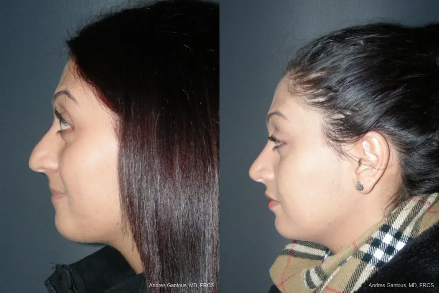 Rhinoplasty: Patient 45 - Before and After 5