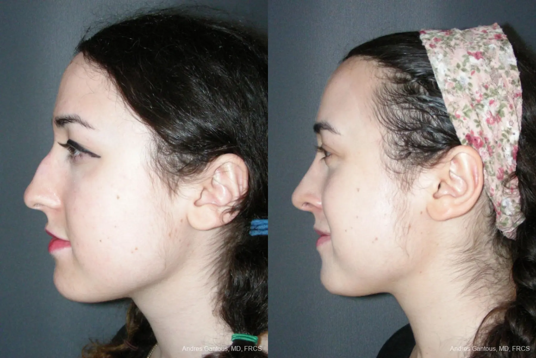 Rhinoplasty: Patient 57 - Before and After 5