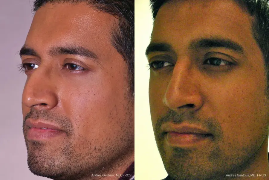 Rhinoplasty: Patient 23 - Before and After 3