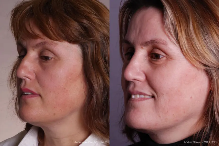 Rhinoplasty: Patient 40 - Before and After 4