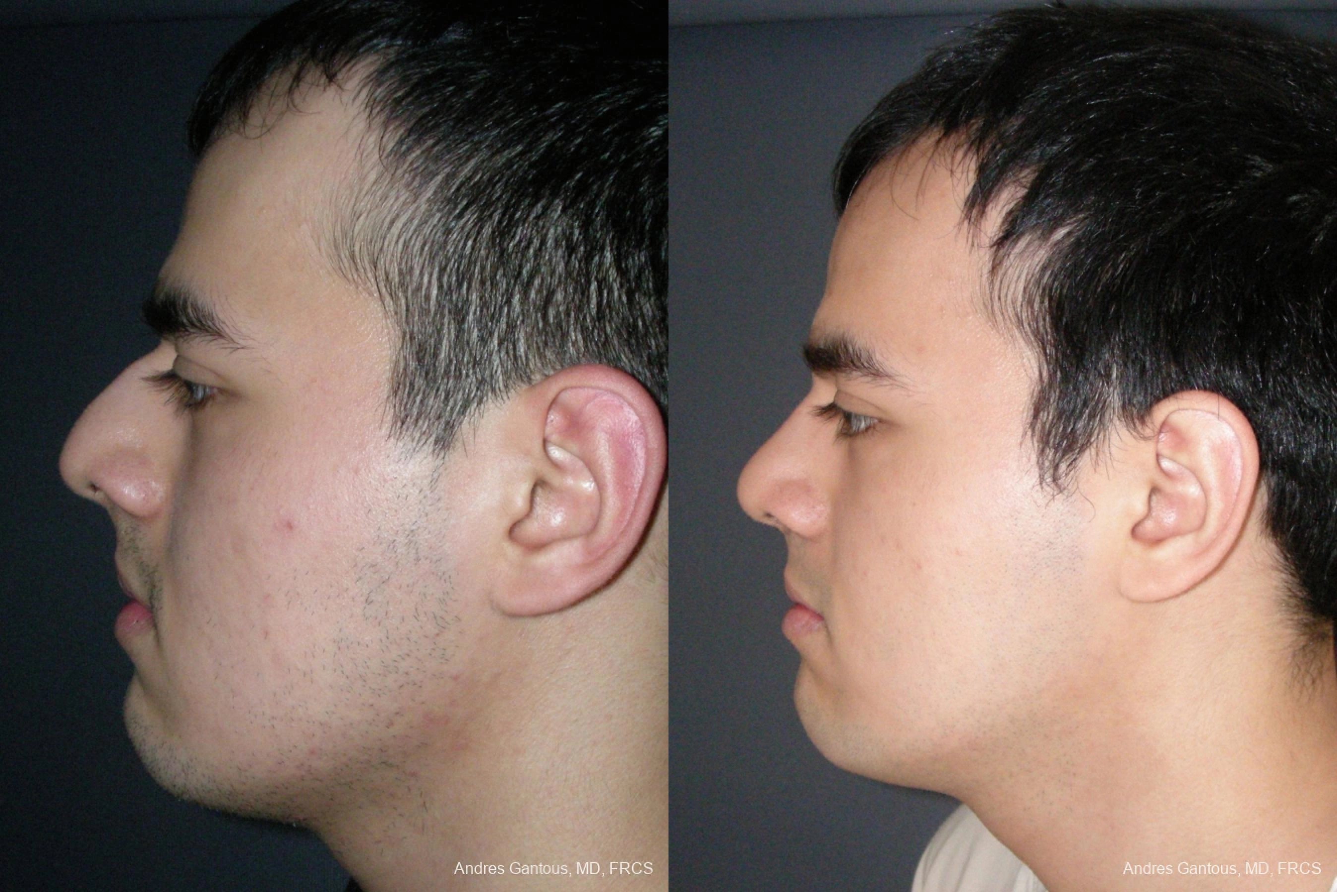 Rhinoplasty - Thumbnail 5