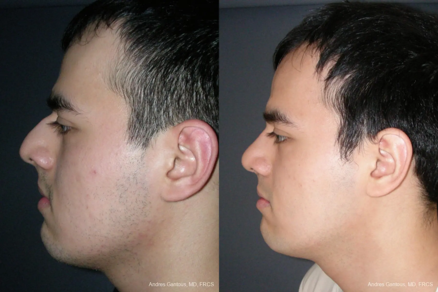 Rhinoplasty: Patient 54 - Before and After 5