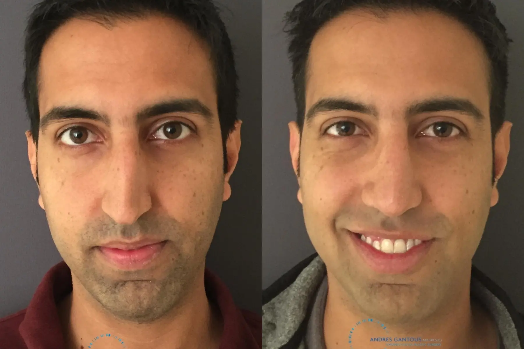Rhinoplasty: Patient 74 - Before and After  