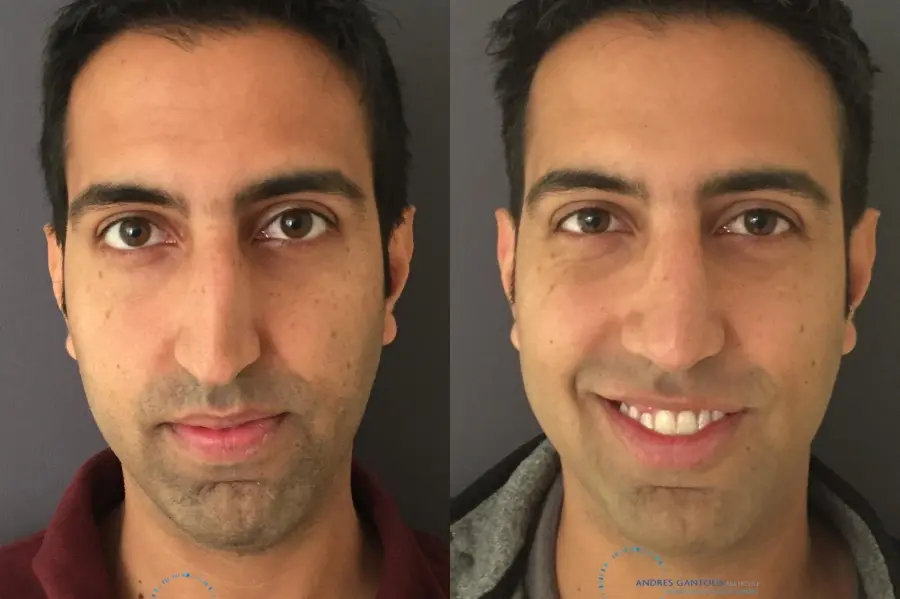 Rhinoplasty: Patient 76 - Before and After 1