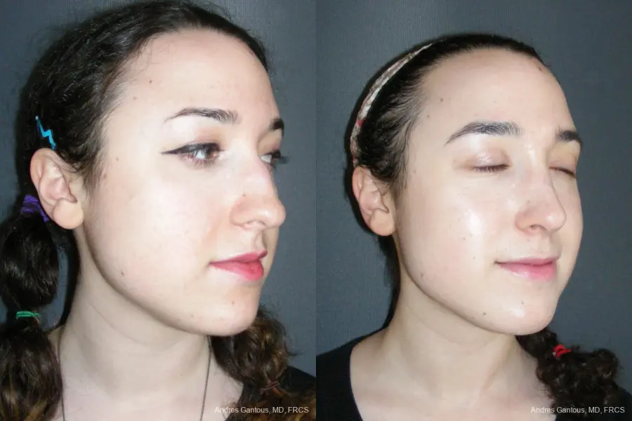 Rhinoplasty: Patient 57 - Before and After 2
