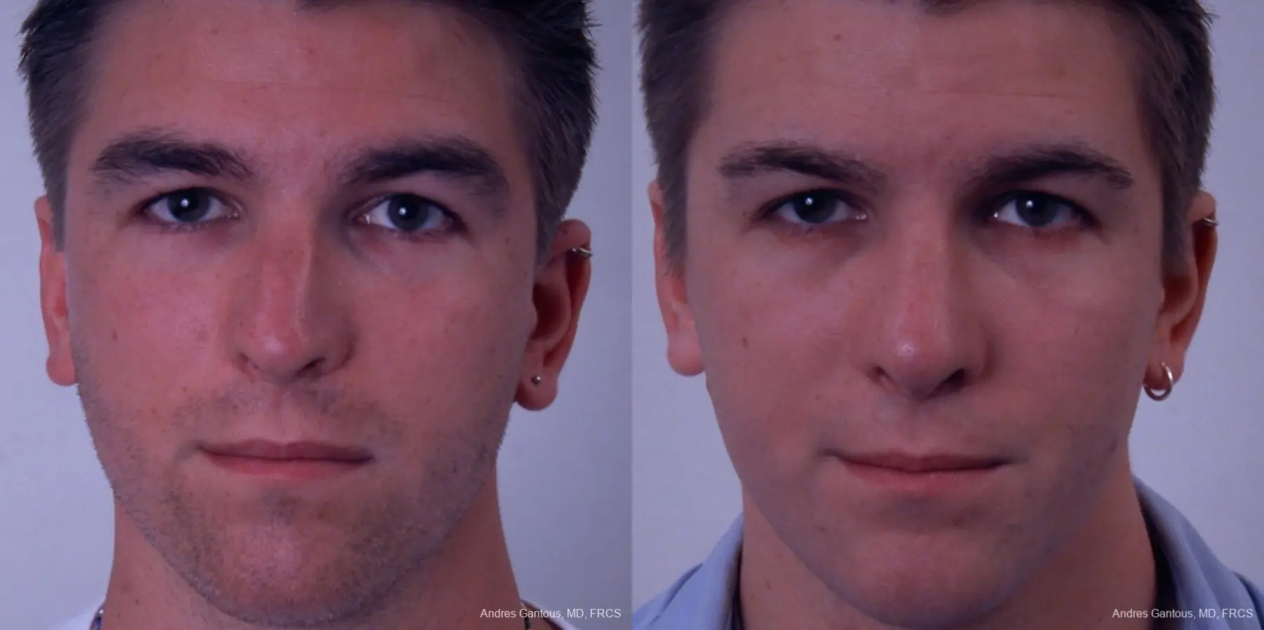 Rhinoplasty: Patient 33 - Before and After 1