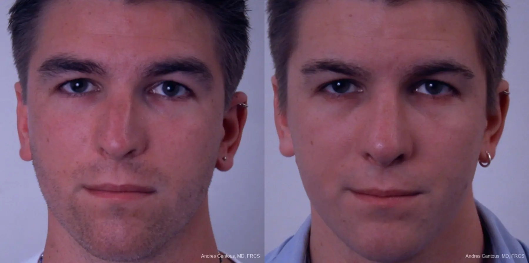 Rhinoplasty: Patient 33 - Before and After  