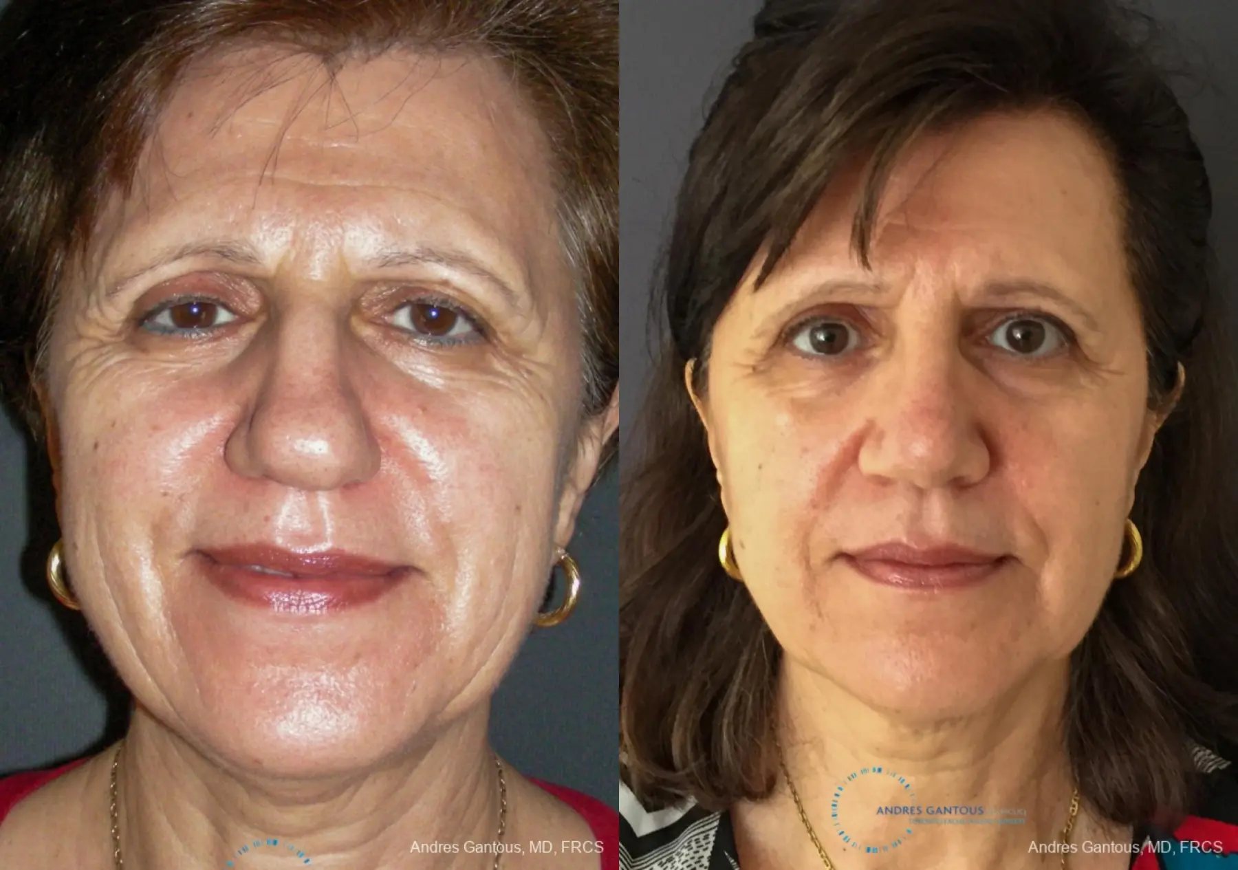 Rhinoplasty: Patient 95 - Before and After 1