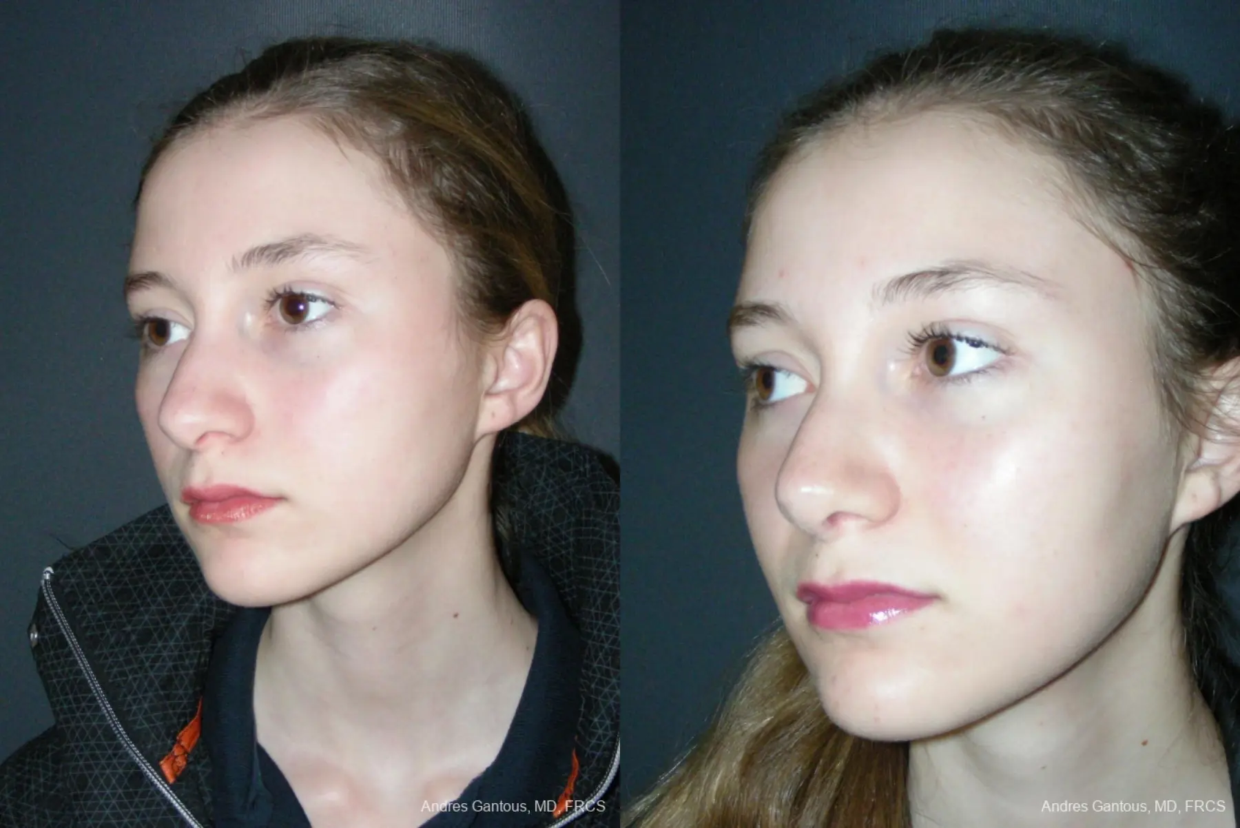 Rhinoplasty: Patient 55 - Before and After 4