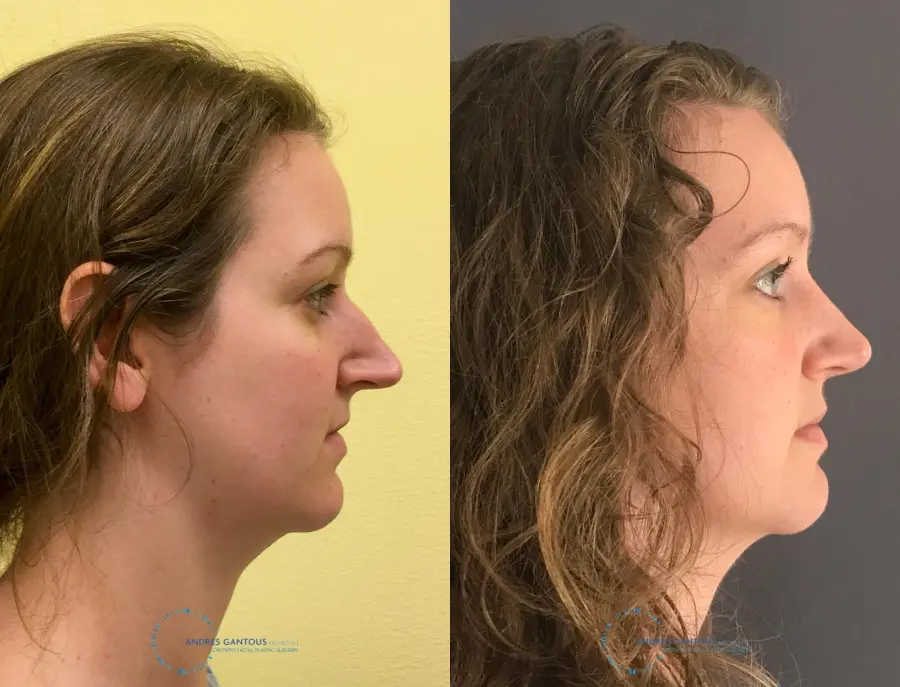 Rhinoplasty: Patient 64 - Before and After 6