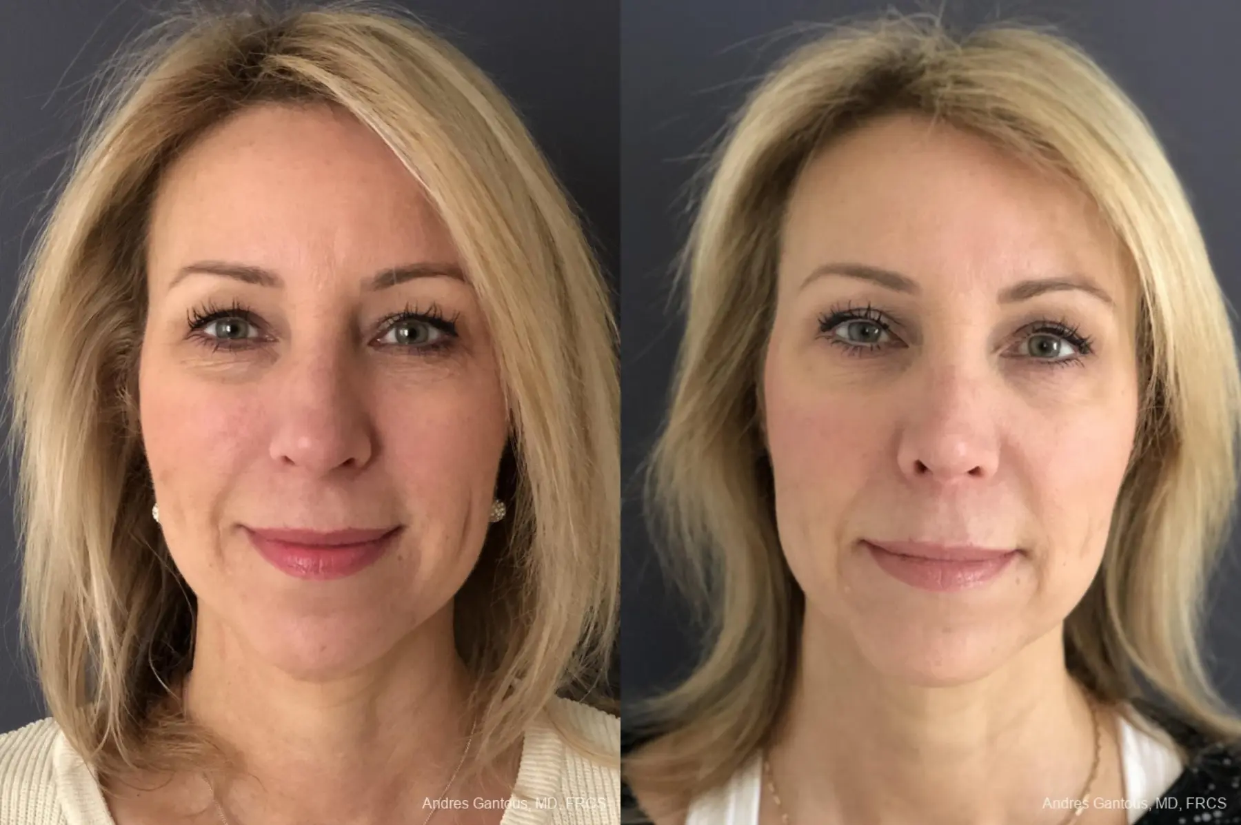 Rhinoplasty: Patient 15 - Before and After  