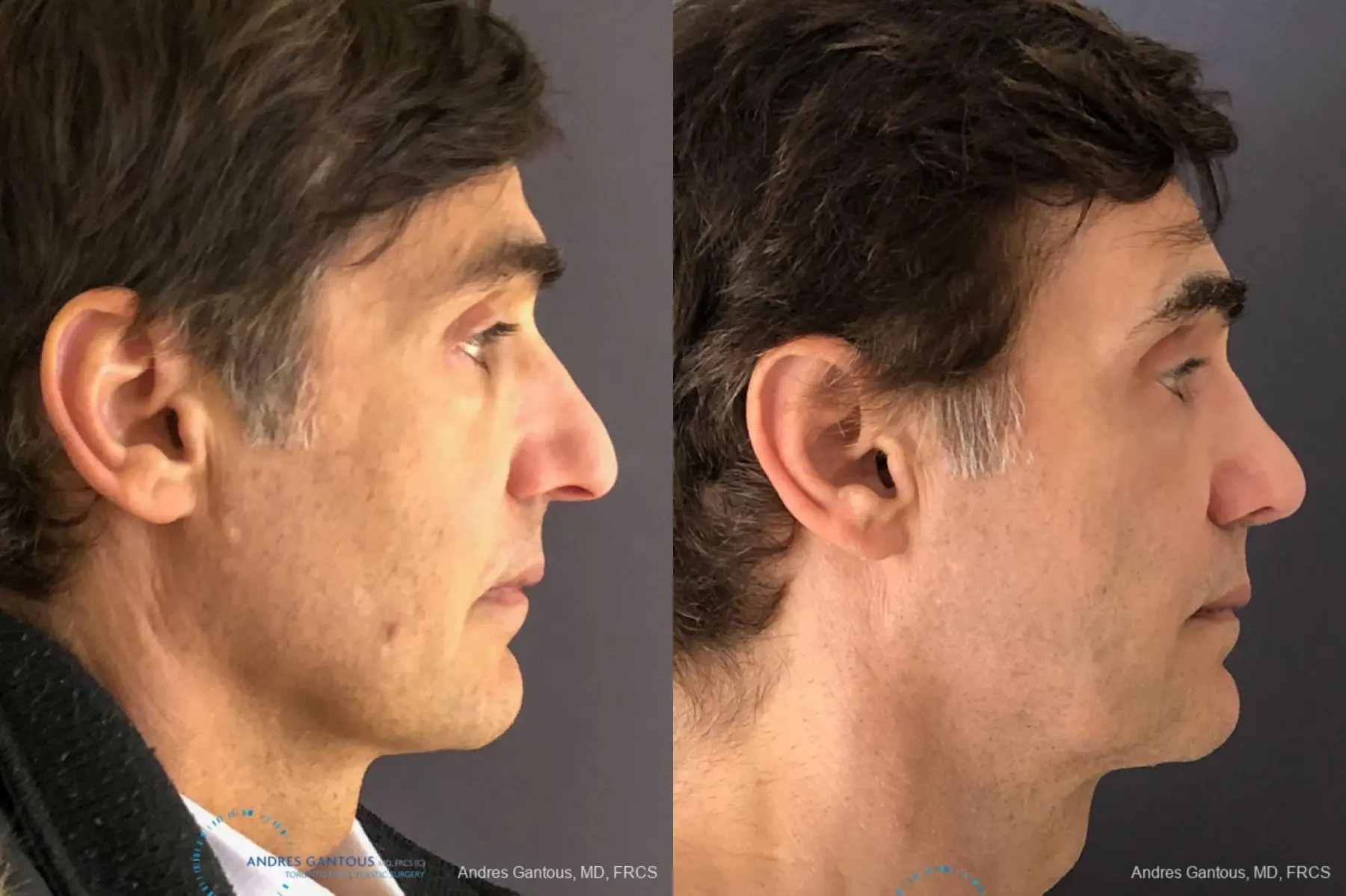 Rhinoplasty: Patient 78 - Before and After 5