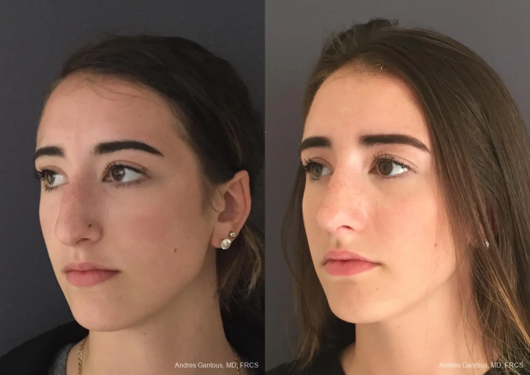 Rhinoplasty: Patient 95 - Before and After 4