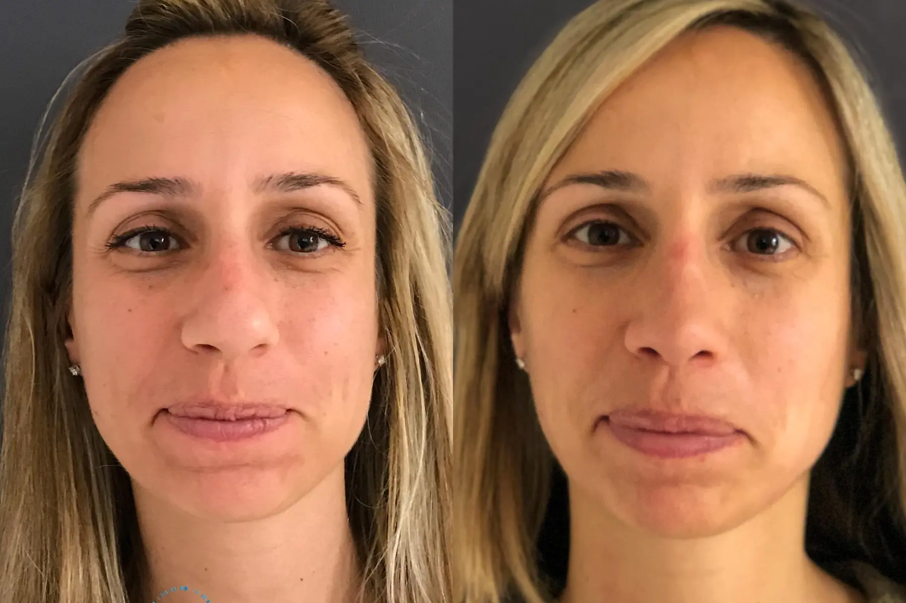 Rhinoplasty: Patient 71 - Before and After 1