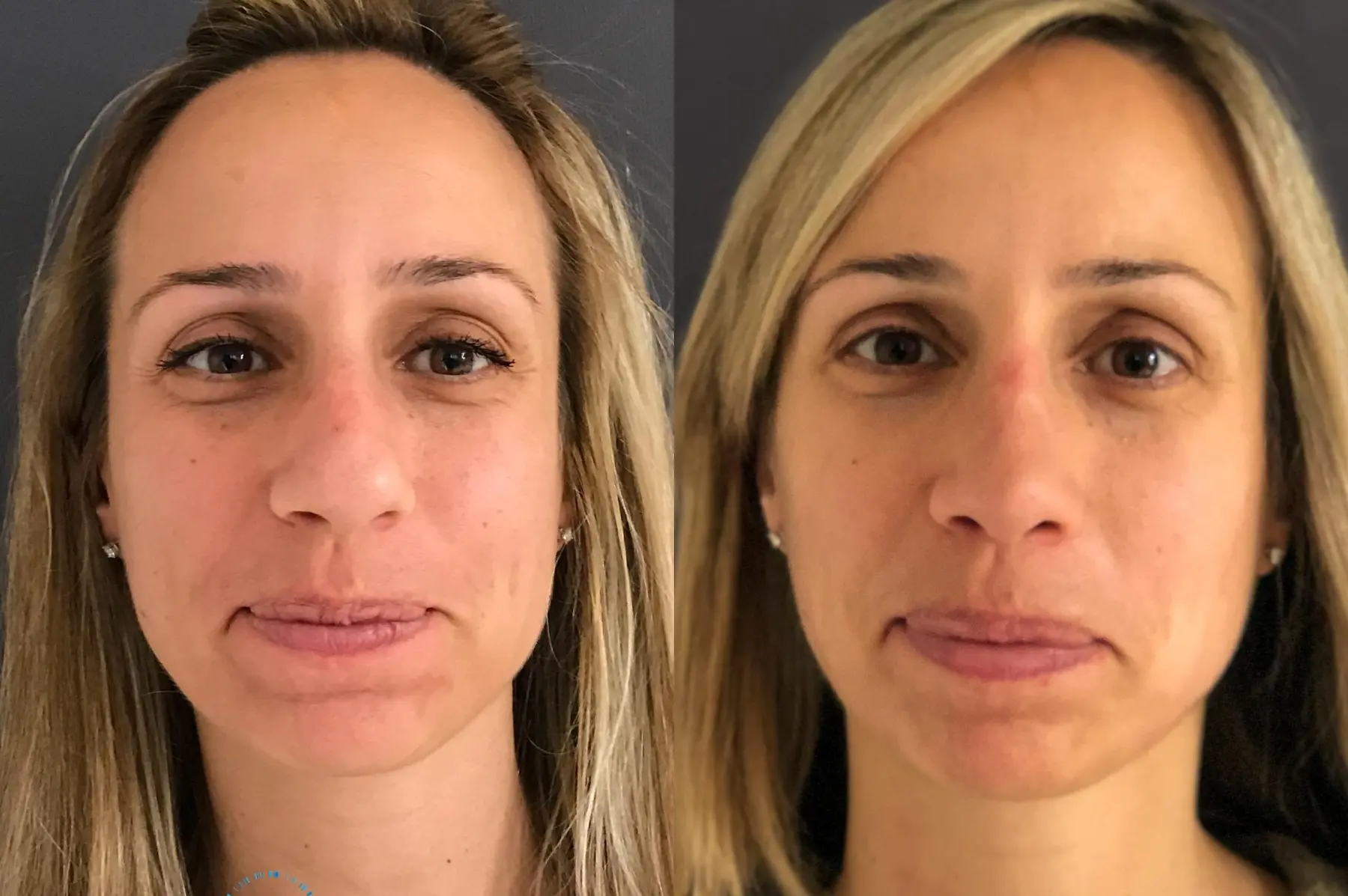 Rhinoplasty: Patient 71 - Before and After  