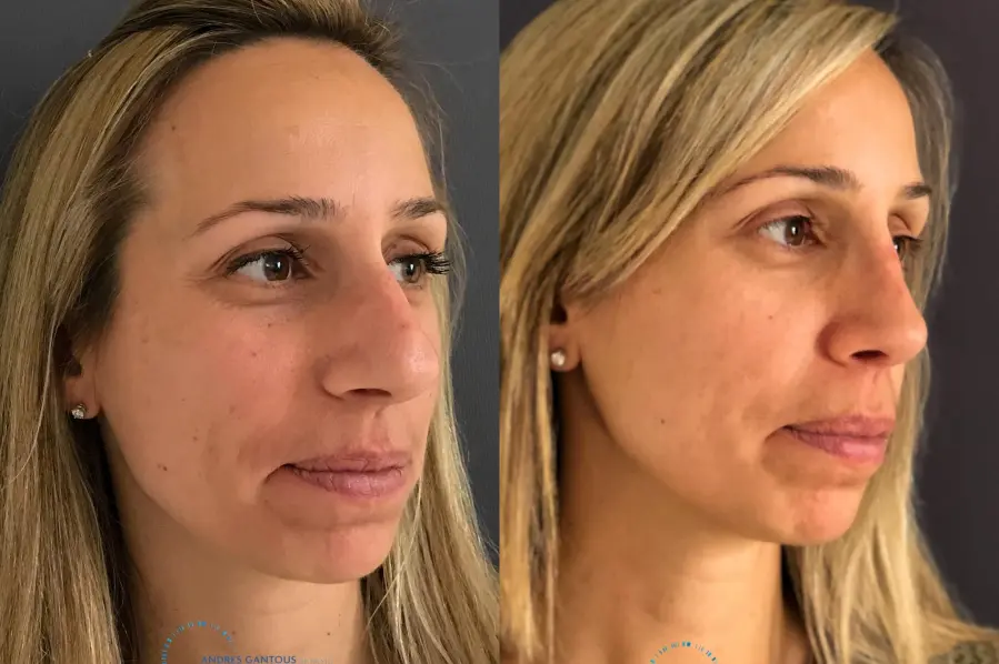 Rhinoplasty: Patient 73 - Before and After 2