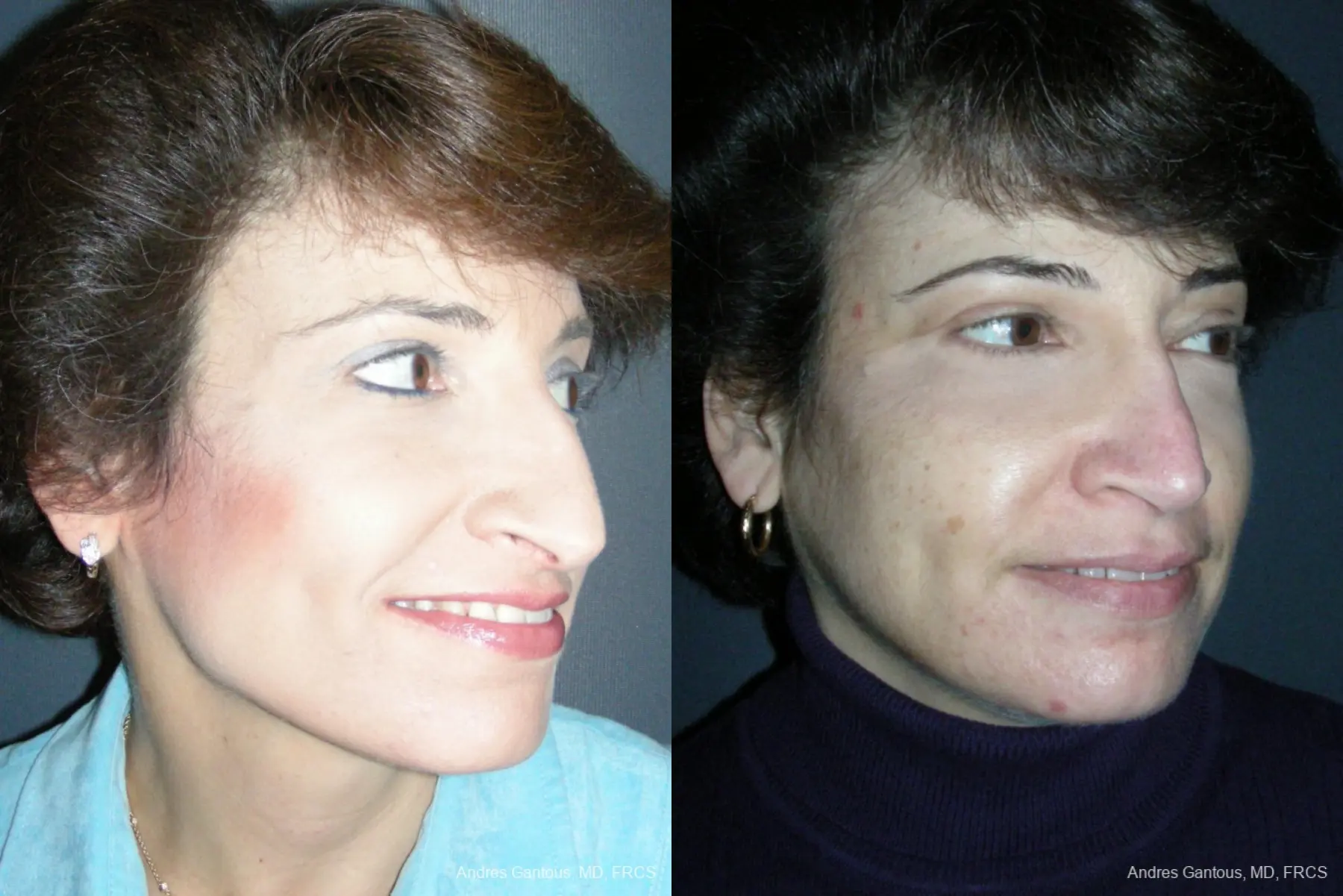 Rhinoplasty: Patient 49 - Before and After 4