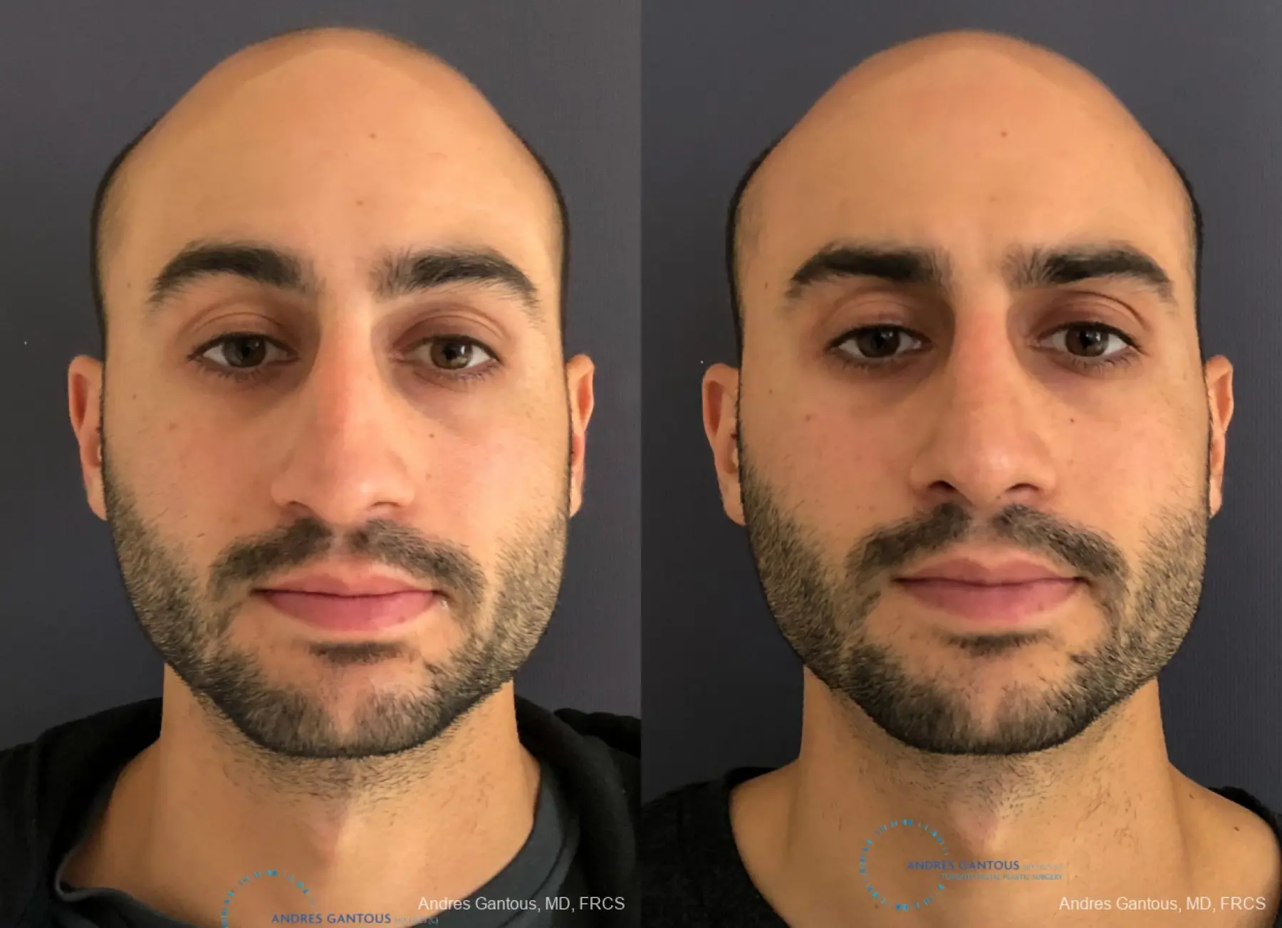 Rhinoplasty: Patient 87 - Before and After  
