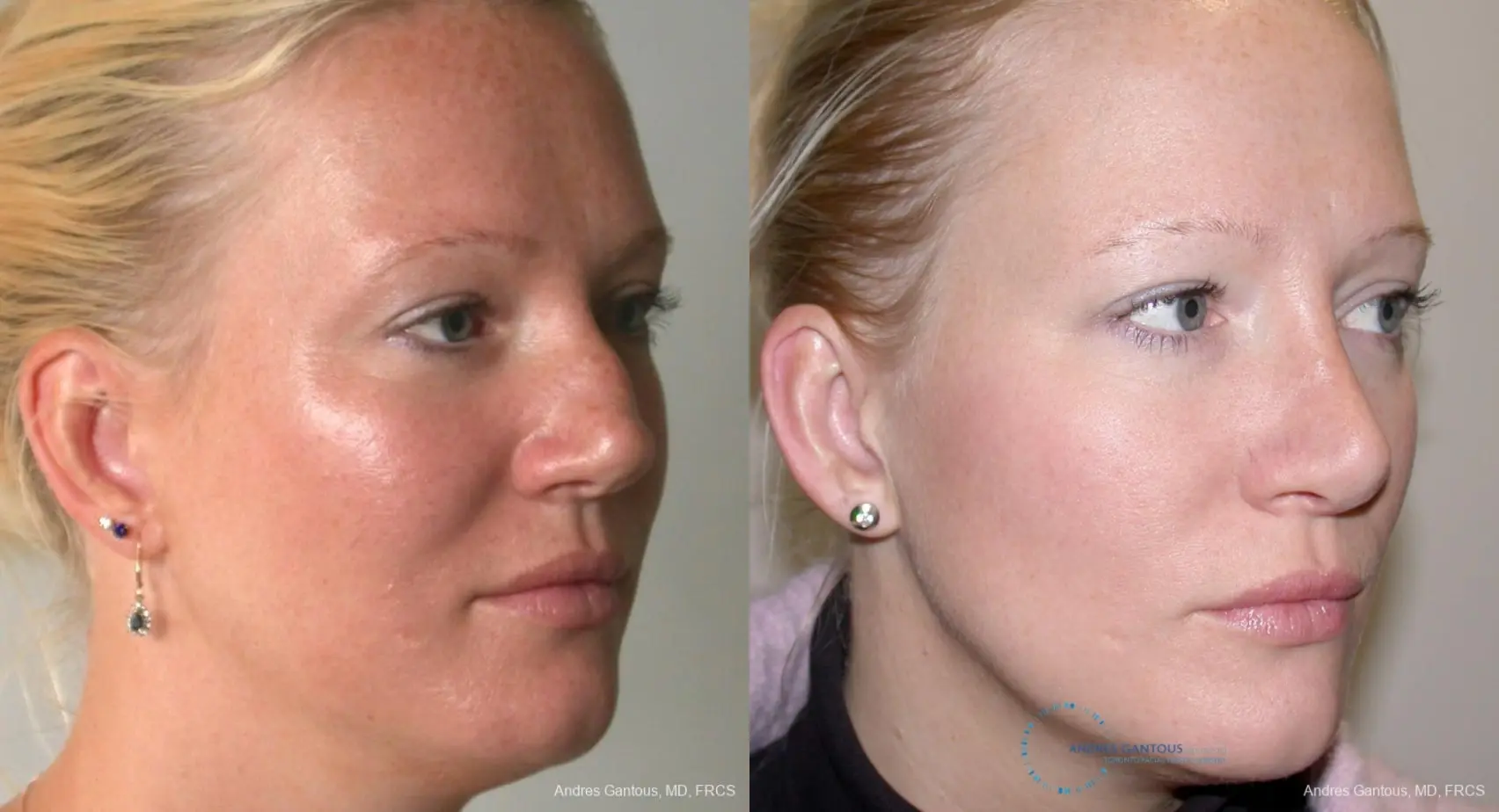 Rhinoplasty: Patient 92 - Before and After 3