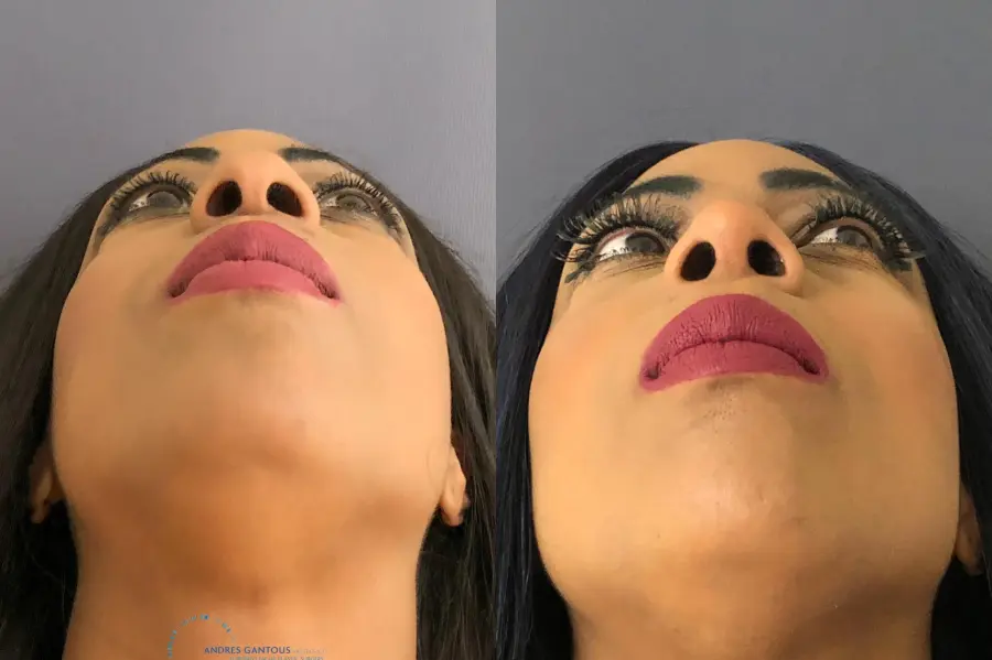 Rhinoplasty: Patient 66 - Before and After 2
