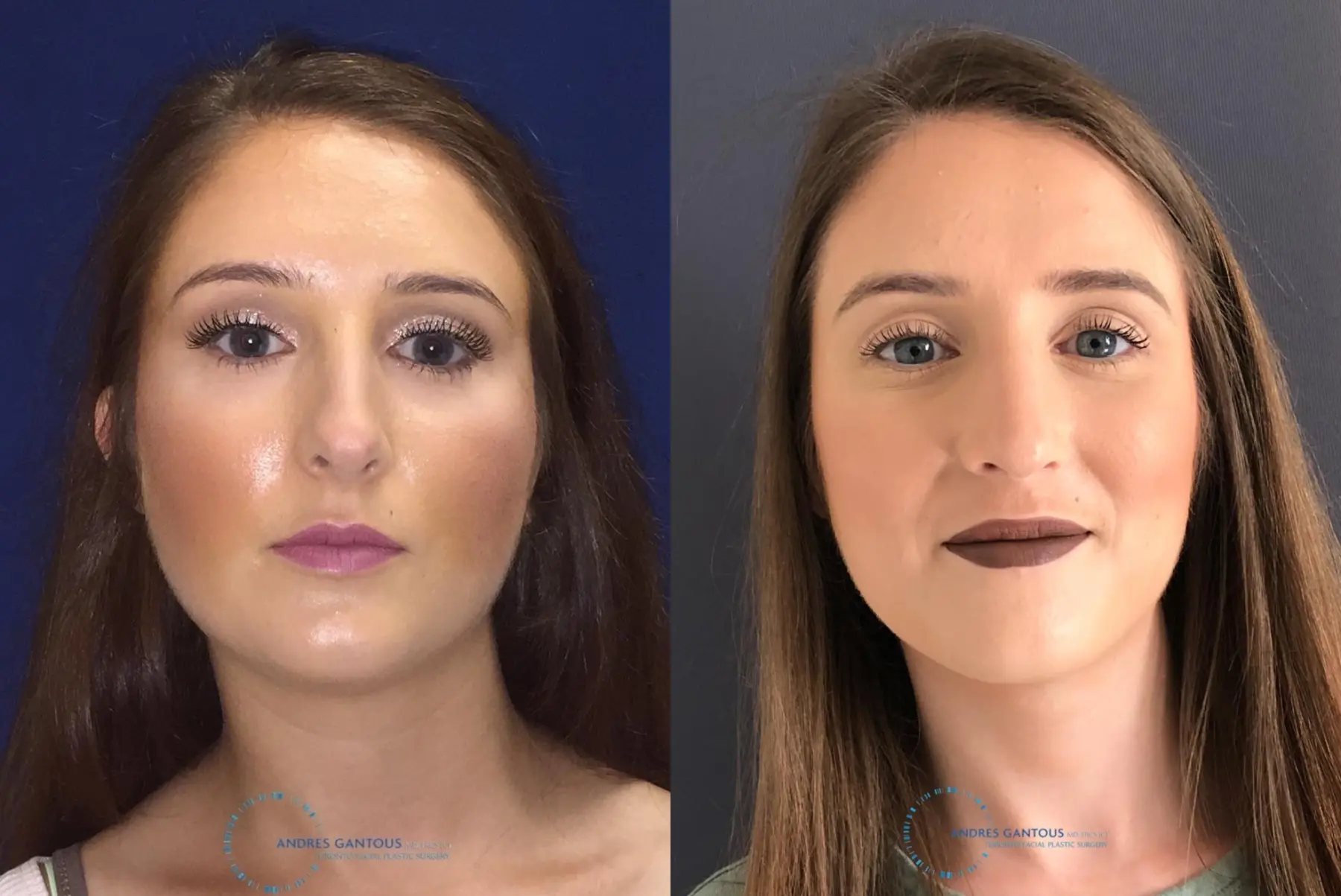 Rhinoplasty: Patient 1 - Before and After 1