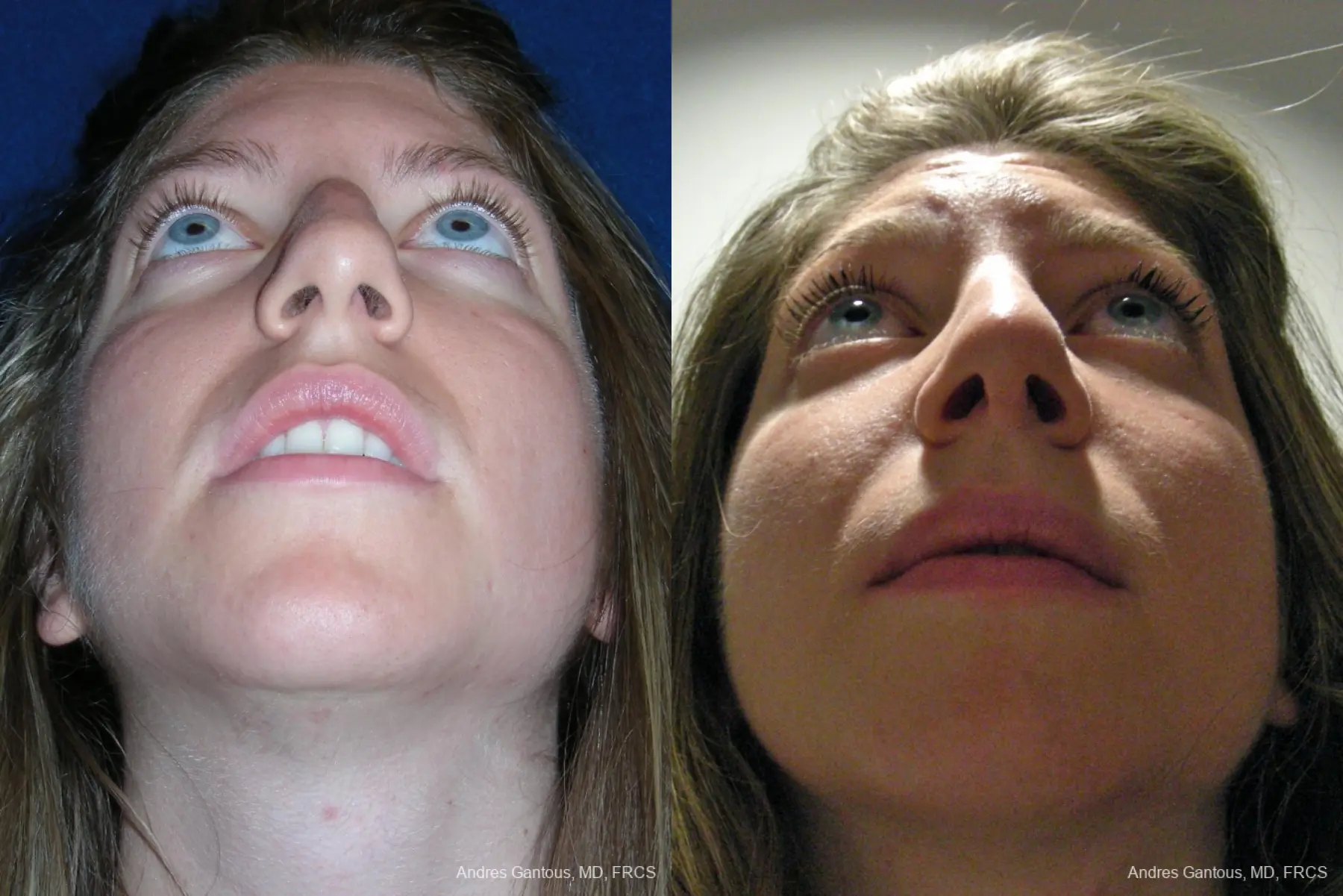 Rhinoplasty: Patient 50 - Before and After 6