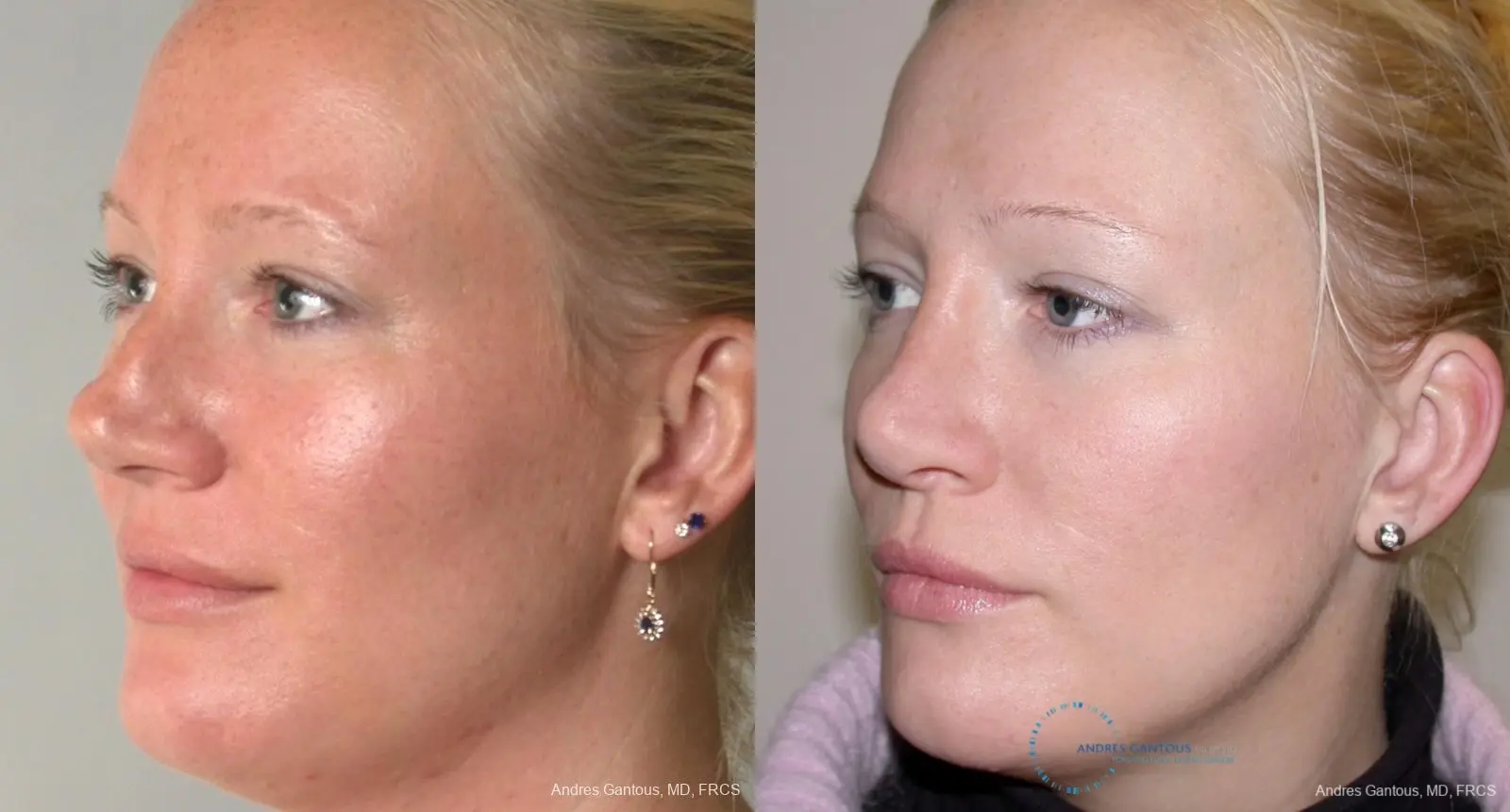 Rhinoplasty: Patient 94 - Before and After 2