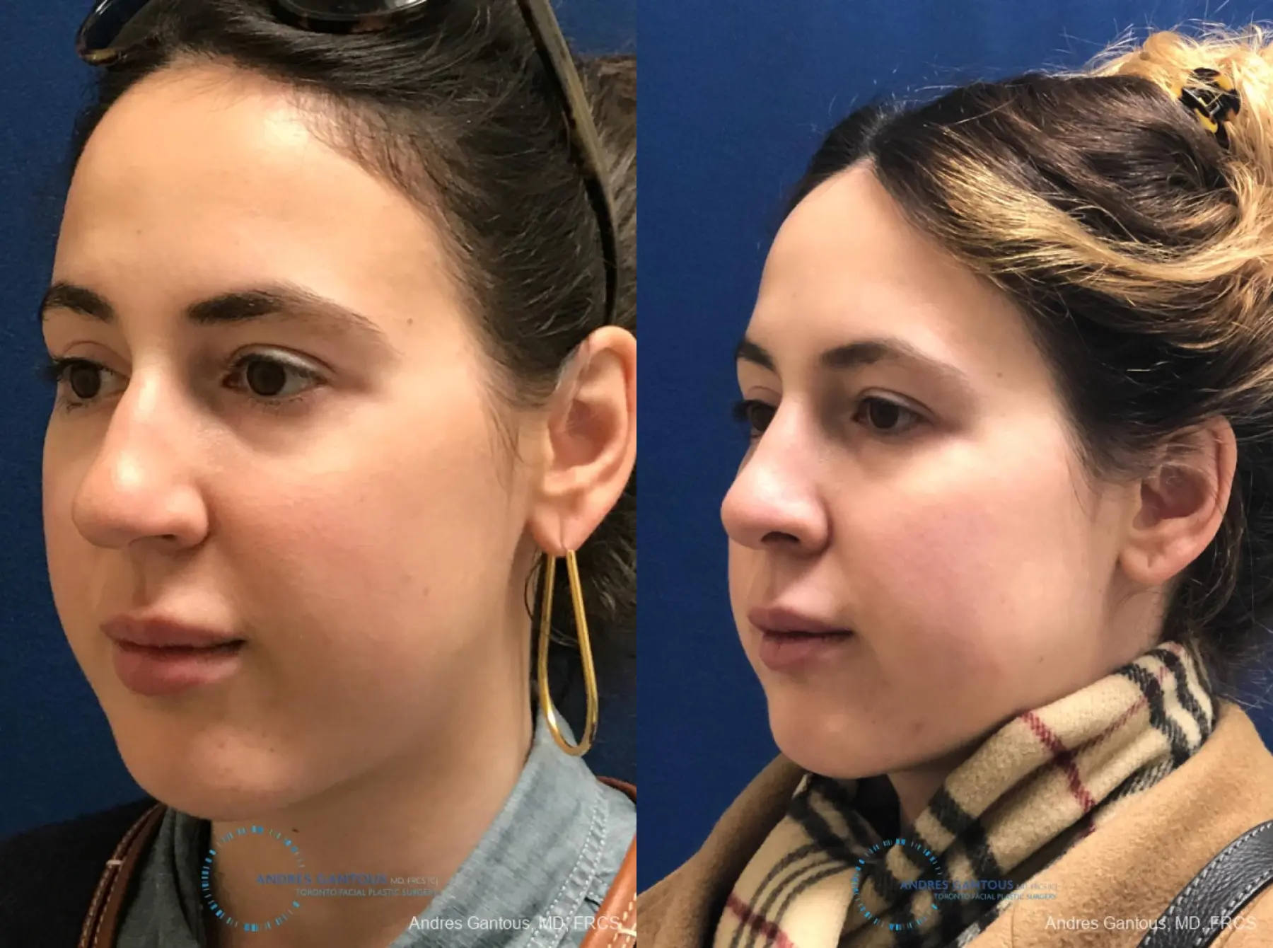 Rhinoplasty: Patient 84 - Before and After 4