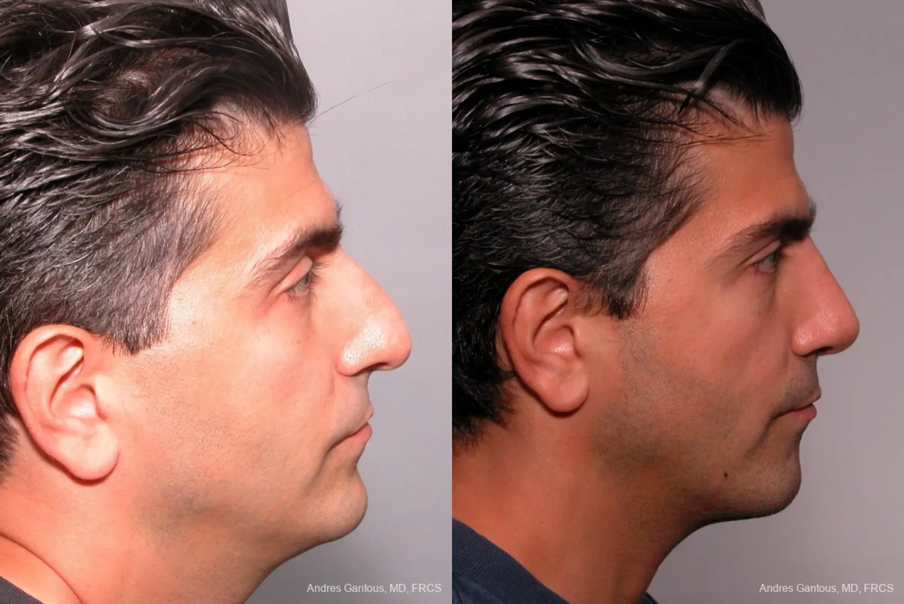 Rhinoplasty: Patient 24 - Before and After 4