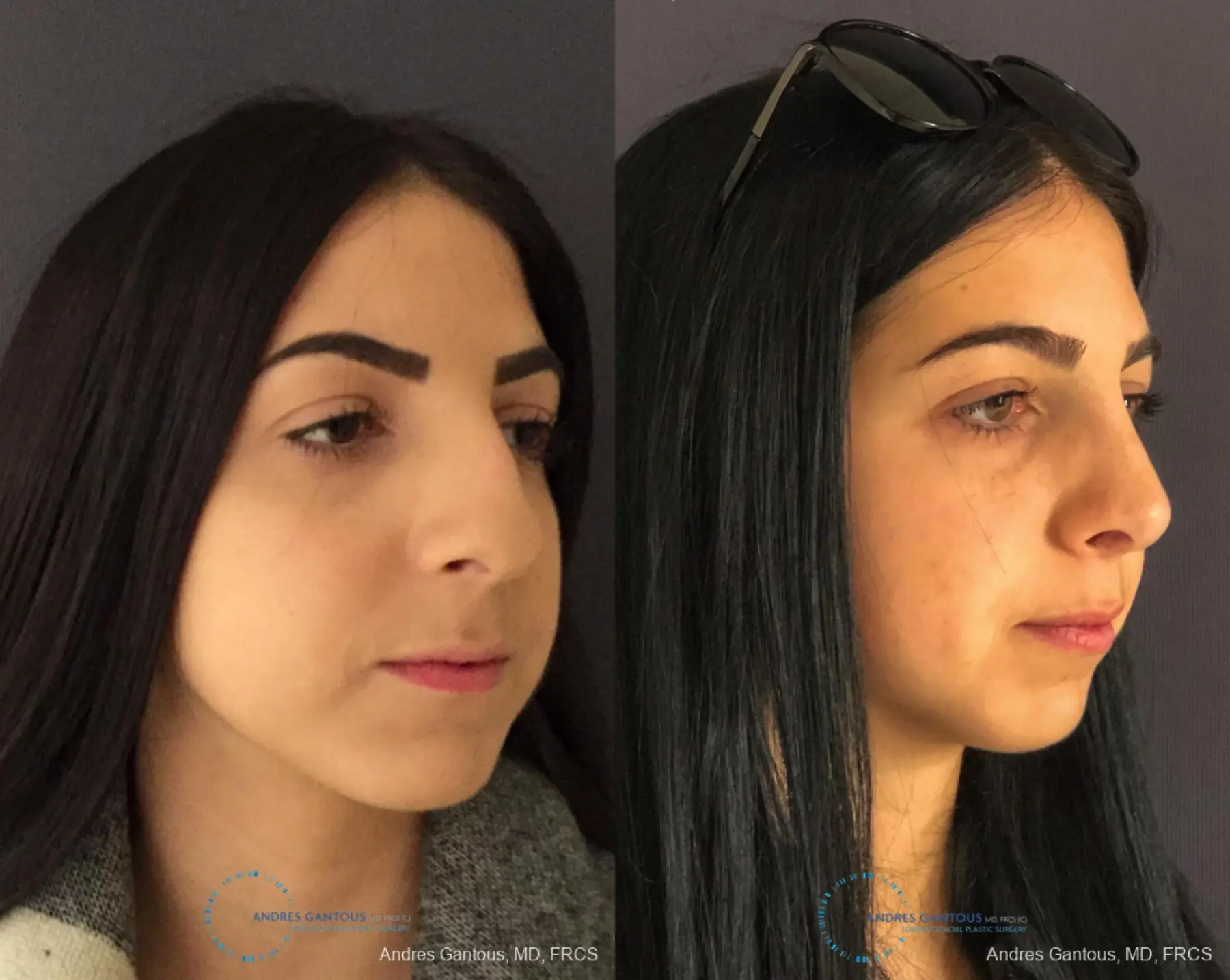 Rhinoplasty: Patient 83 - Before and After 3