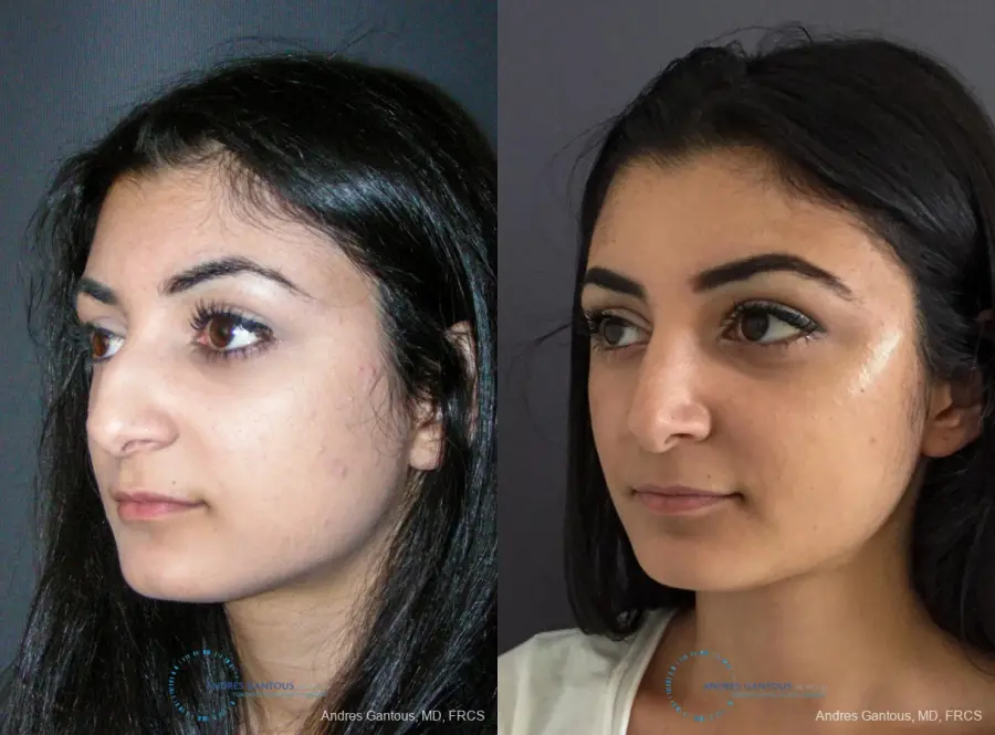 Rhinoplasty: Patient 87 - Before and After 4