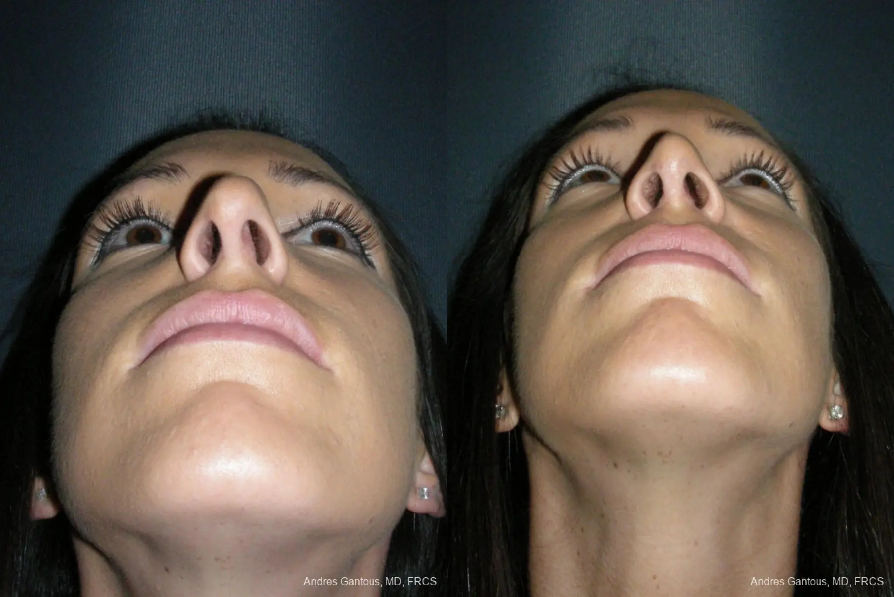Rhinoplasty: Patient 52 - Before and After 6