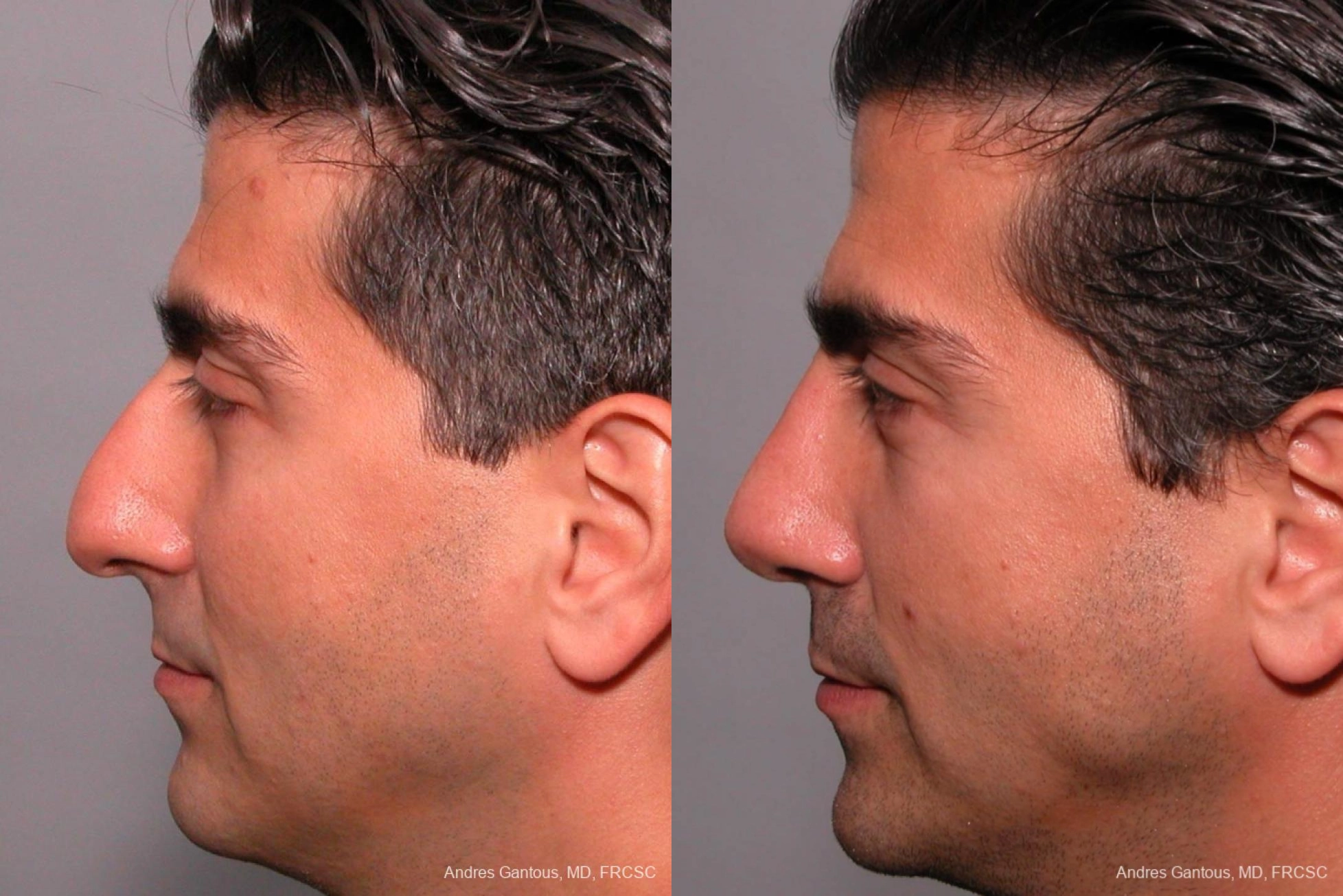 Rhinoplasty - Thumbnail 3