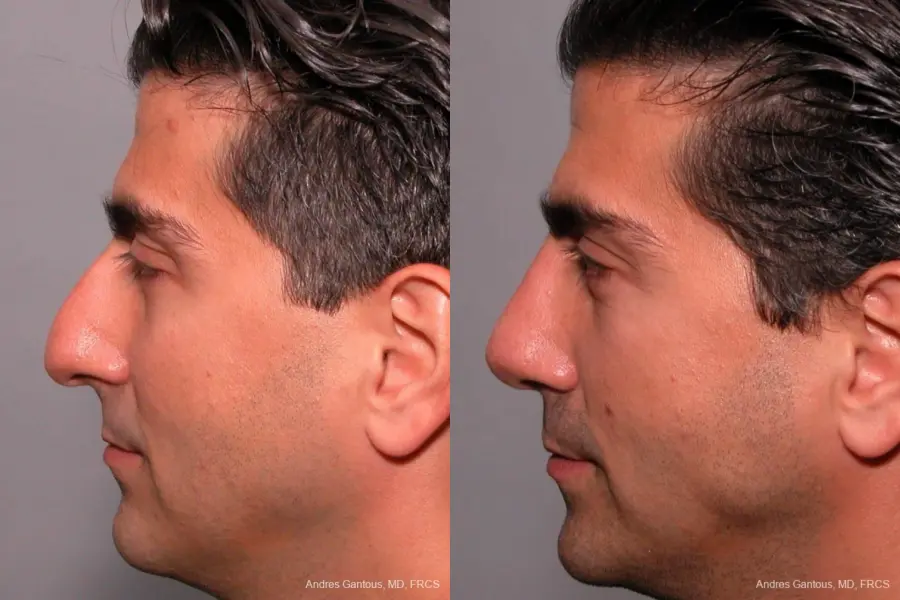 Rhinoplasty: Patient 24 - Before and After 3