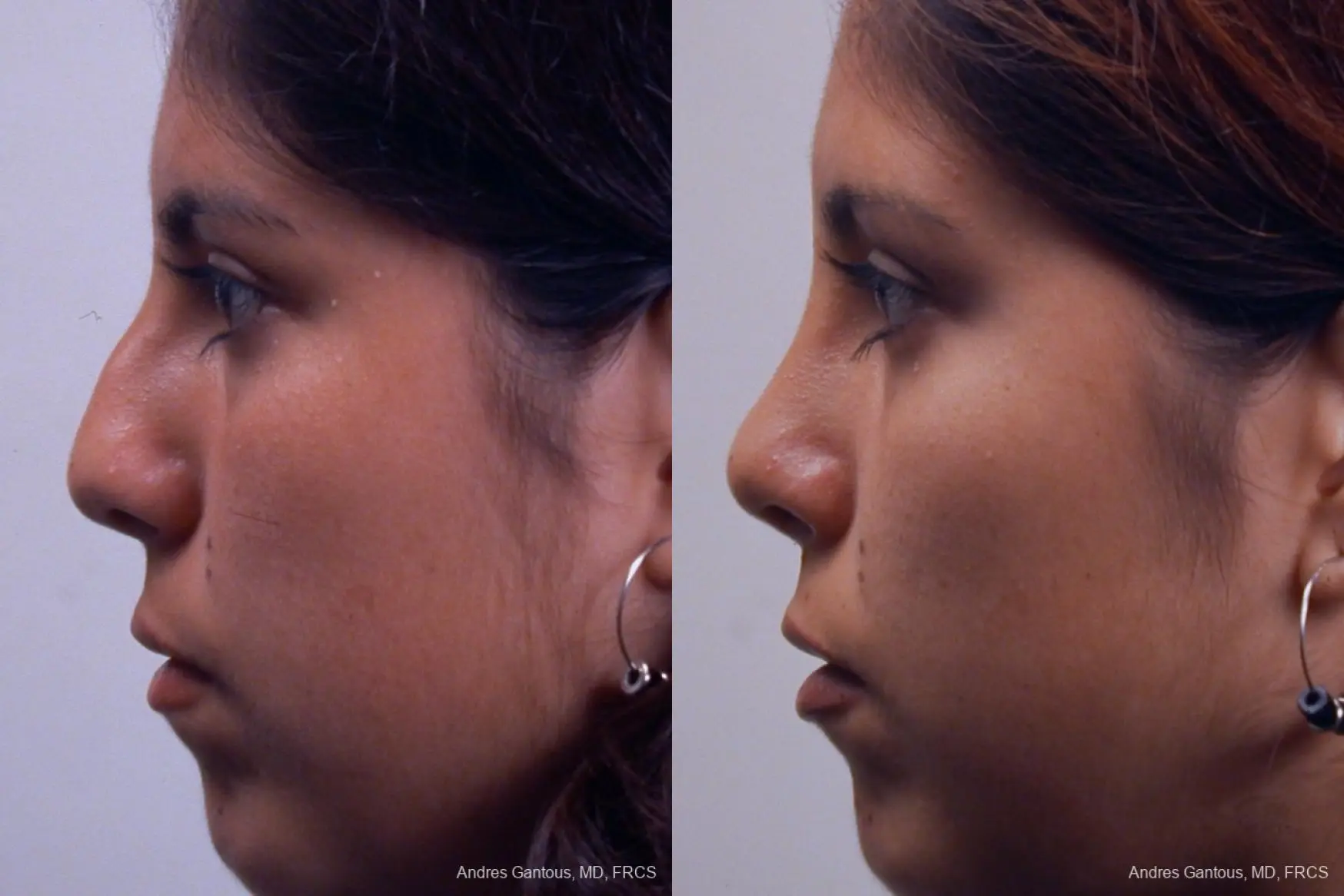 Rhinoplasty: Patient 19 - Before and After 5