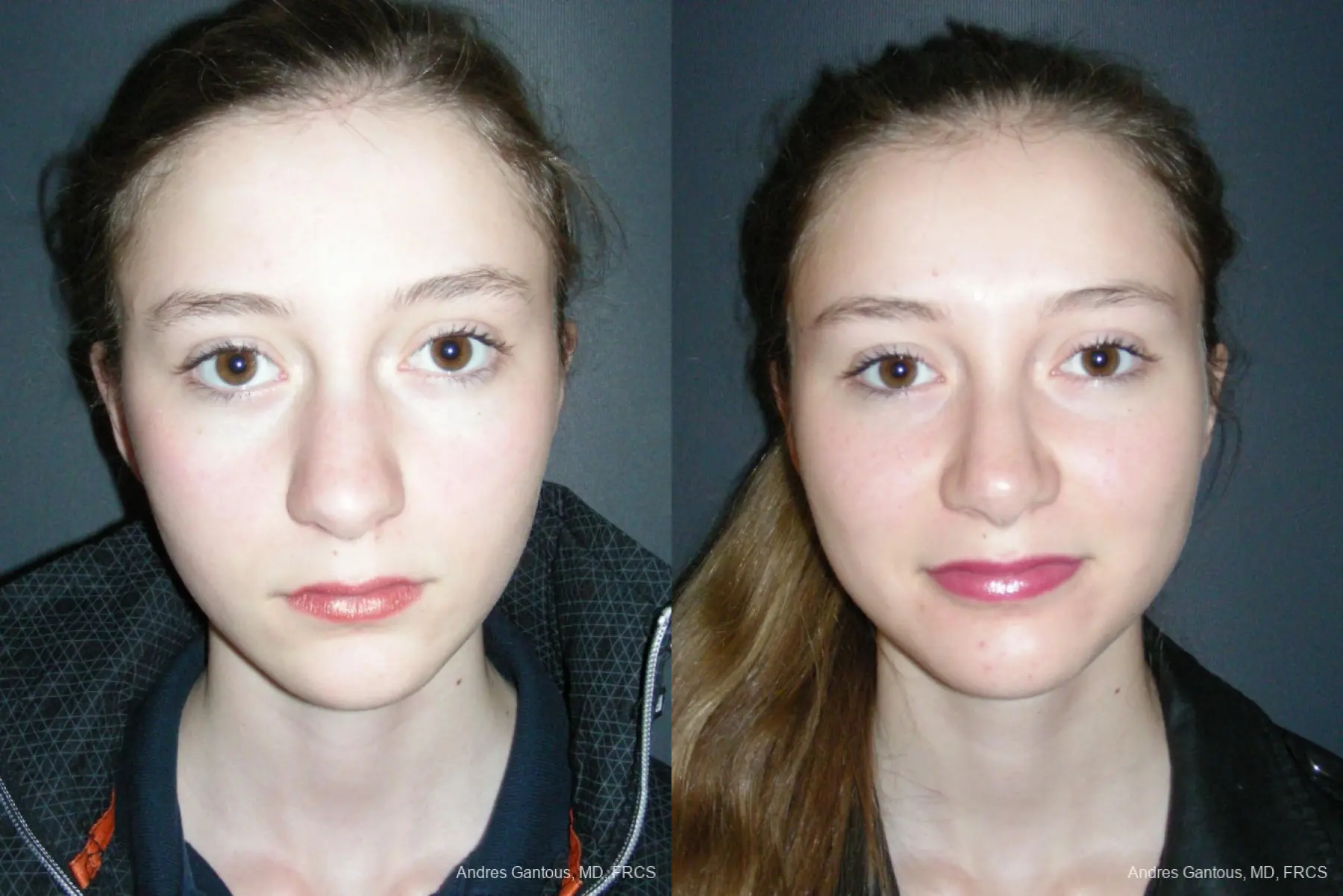 Rhinoplasty: Patient 55 - Before and After 1