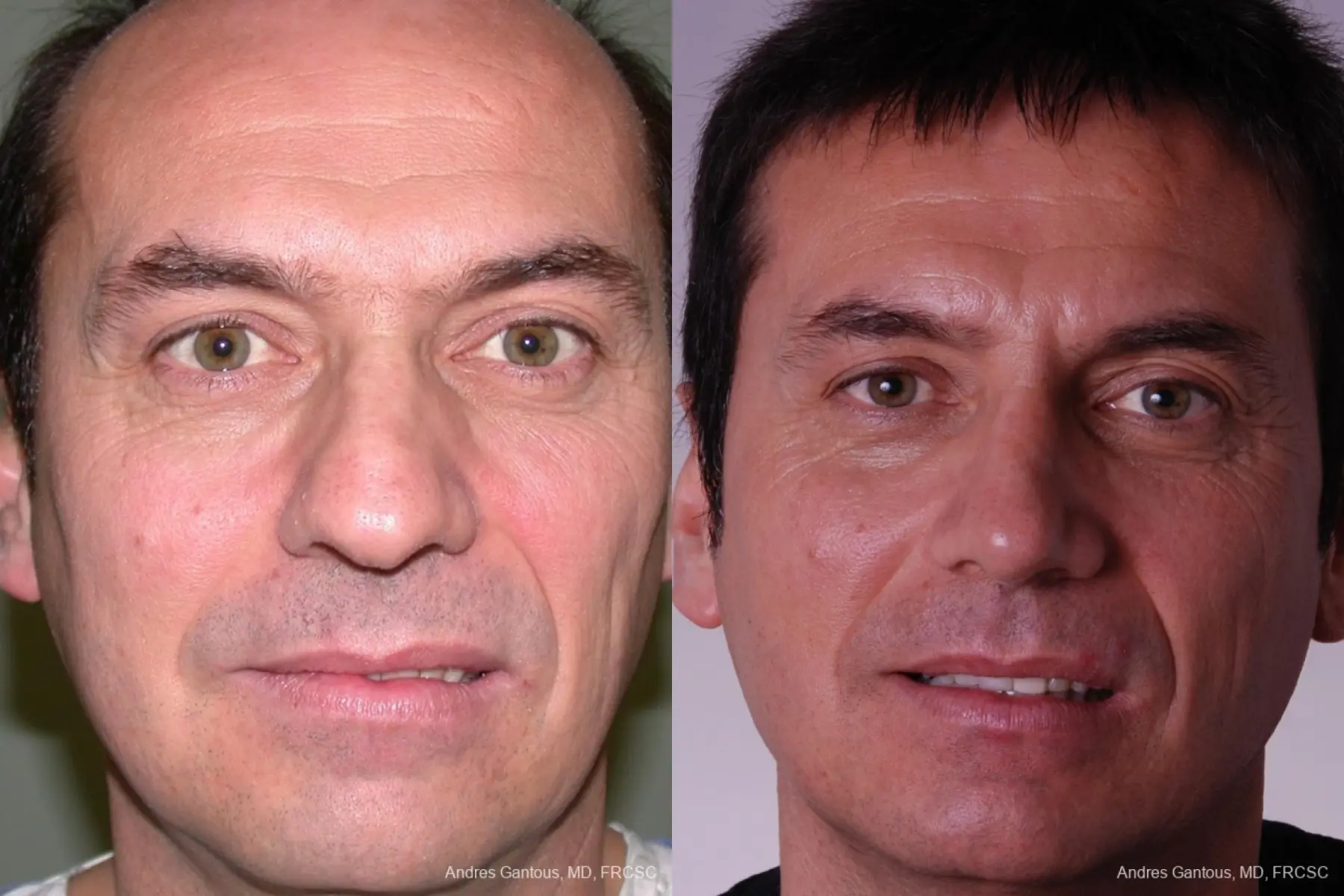 Rhinoplasty: Patient 10 - Before and After  