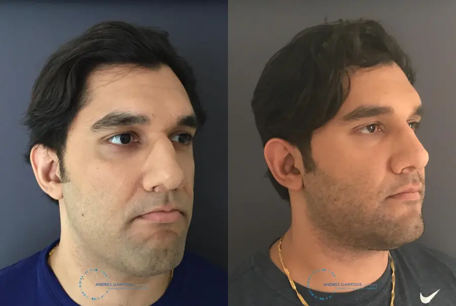 Rhinoplasty: Patient 62 - Before and After 3