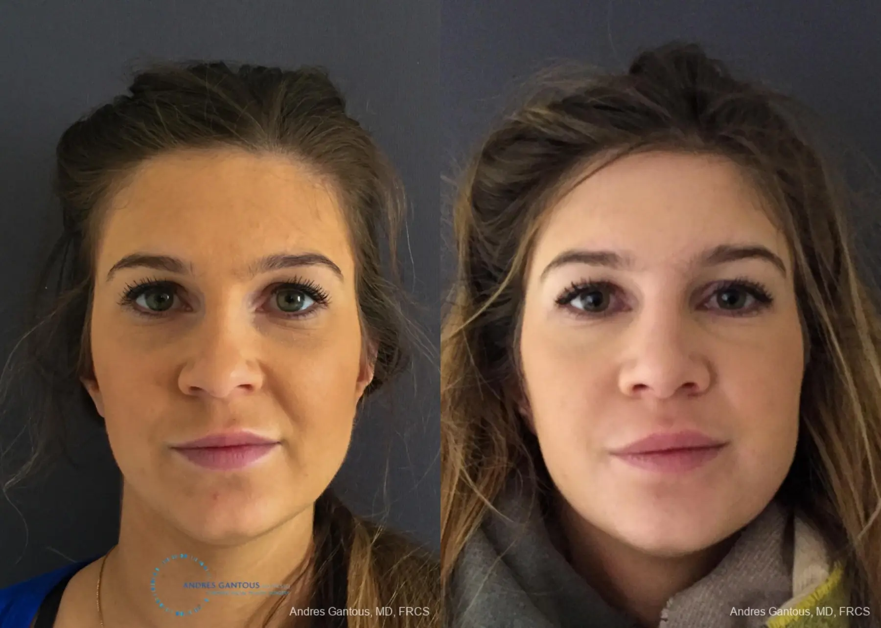 Rhinoplasty: Patient 75 - Before and After  