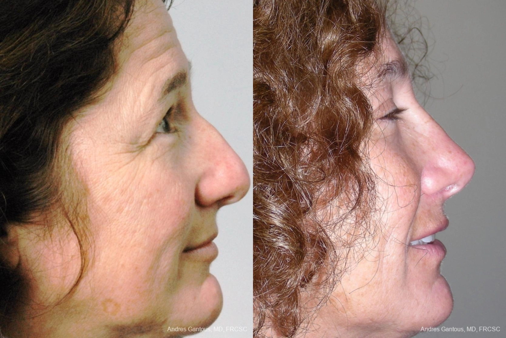 Rhinoplasty - Thumbnail 2